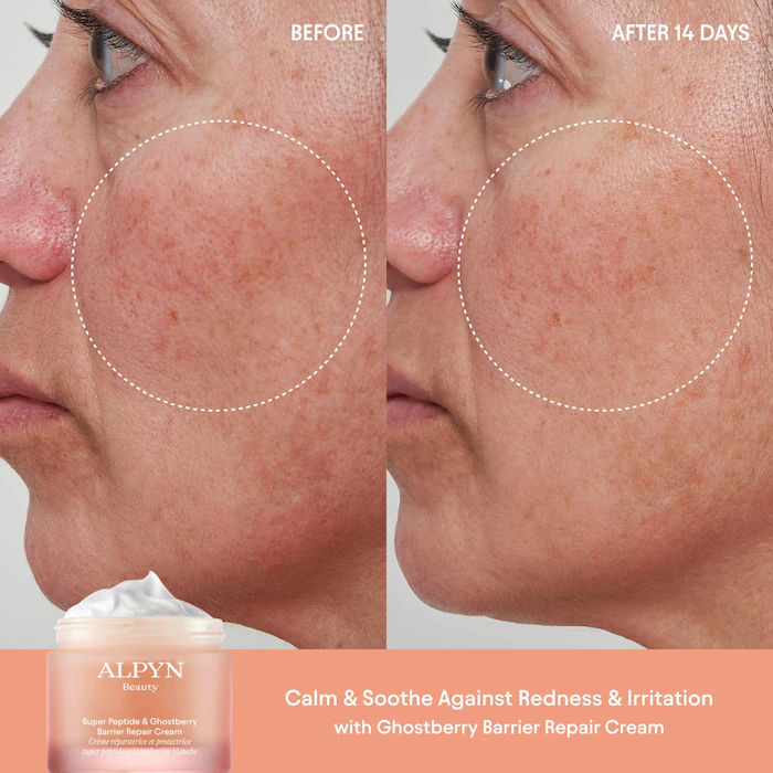 Before and after results of using Alpyn Beauty Super Peptide and Ghostberry Barrier Repair Cream