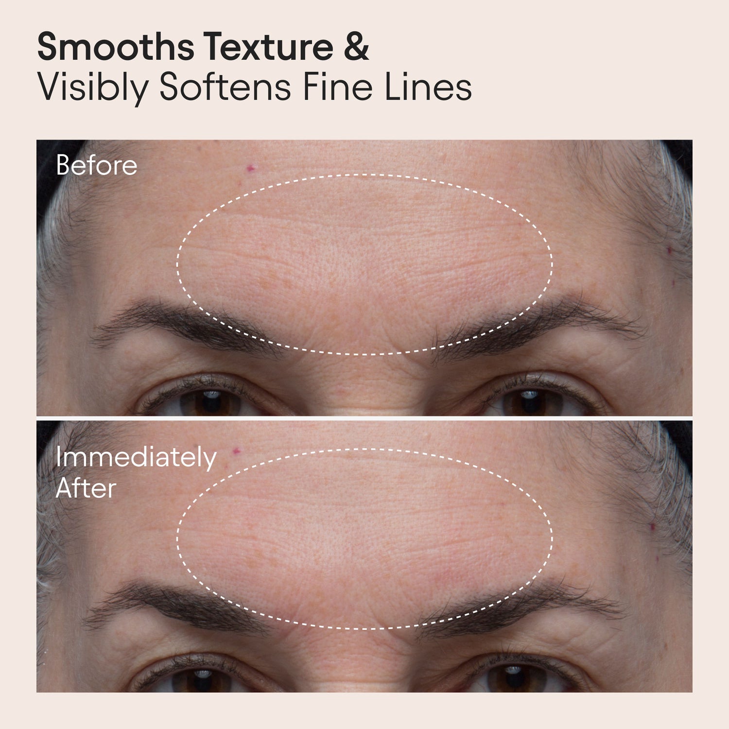 Before and after results of using Alpyn Beauty Polishing Peel and Brightening Face Mask with 8 Acids and Huckleberry