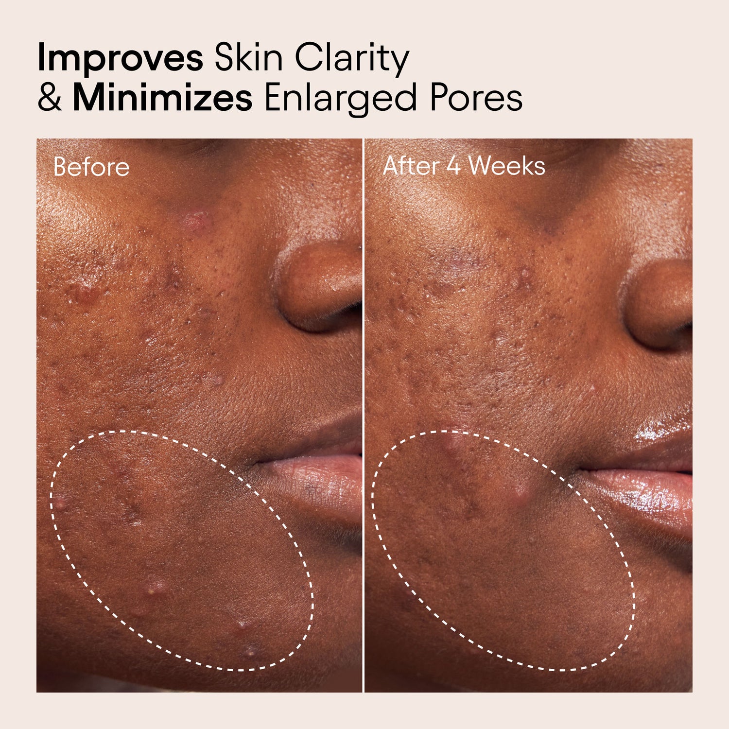 Before and after results of using 2% BHA Pore Perfecting Liquid Exfoliator for Brighter and Clearer Skin