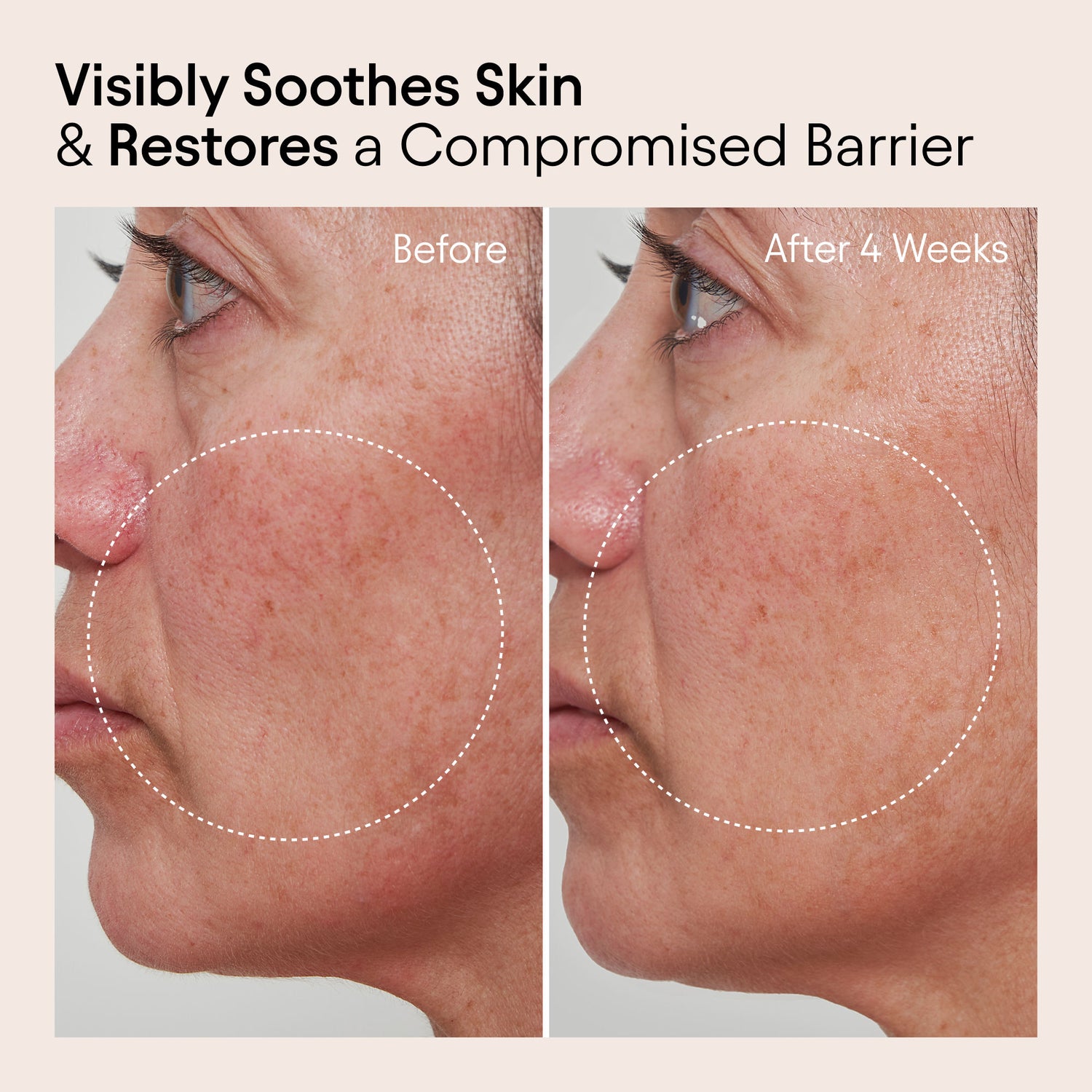 Before and after results of using Alpyn Beauty Barrier Repair Cream Moisturizer for Eczema, Wrinkle and Barrier Repair