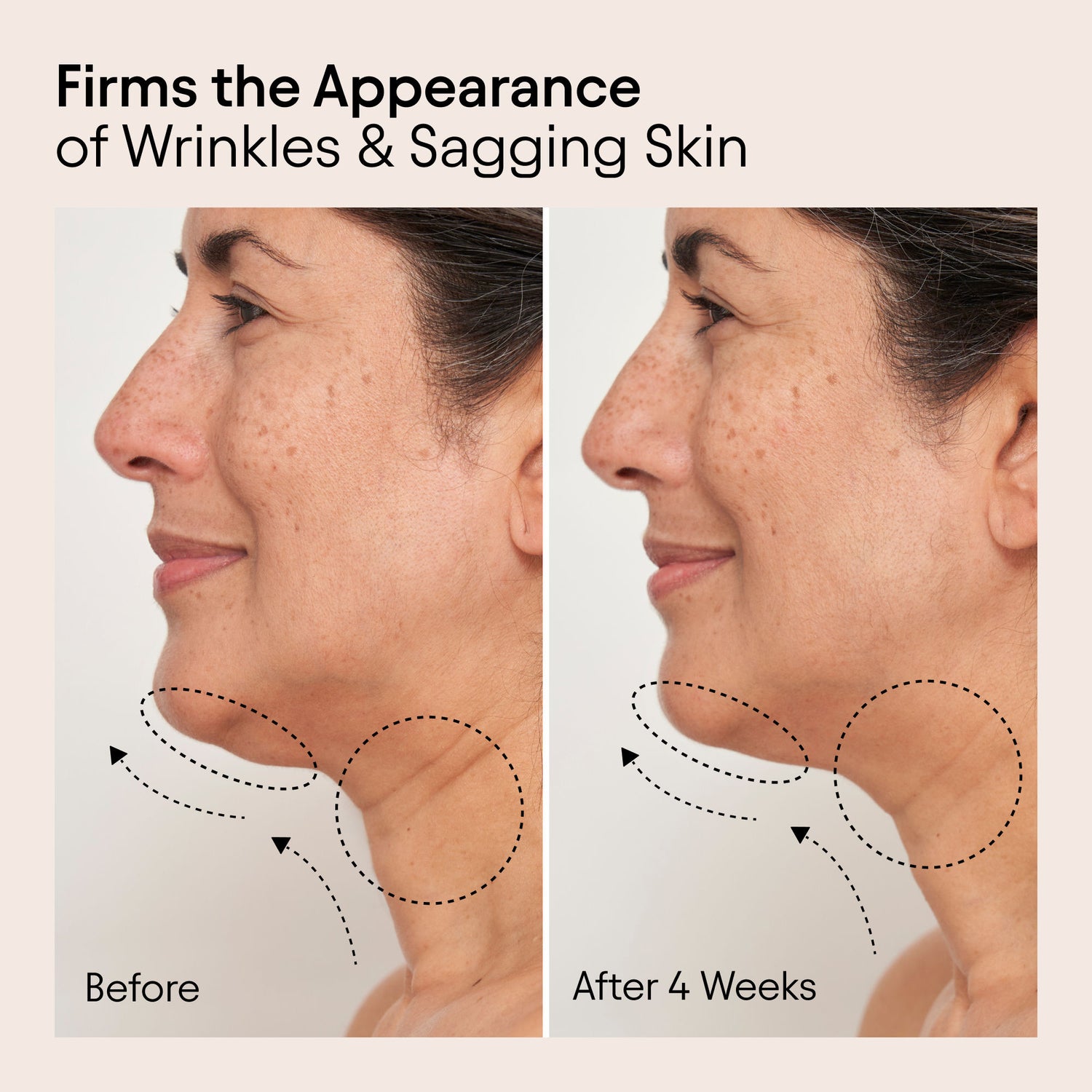 Before and after results of using Alpyn Beauty Super Sculpt Serum For Face and Neck with Tri-Peptide Firming Complex