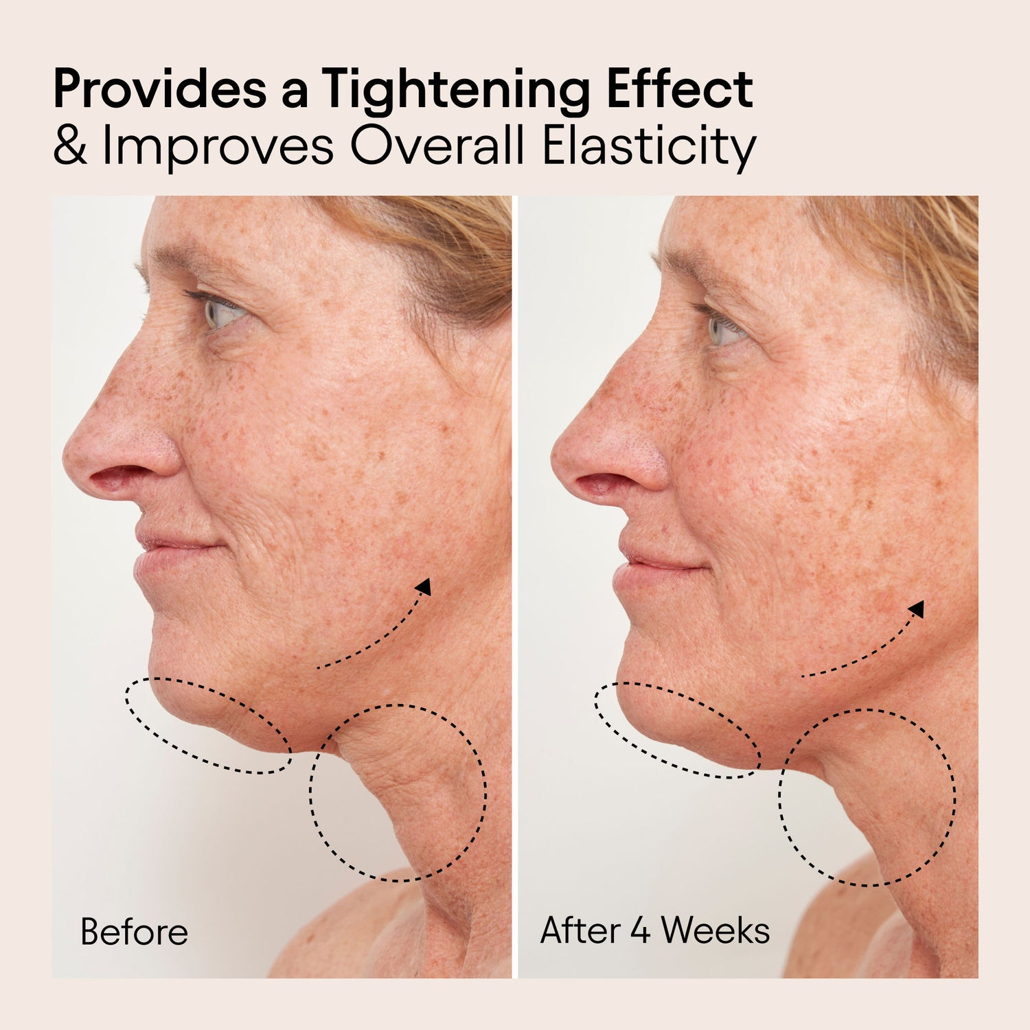 Before and after results of using Alpyn Beauty Super Sculpt Serum For Face and Neck with Tri-Peptide Firming Complex