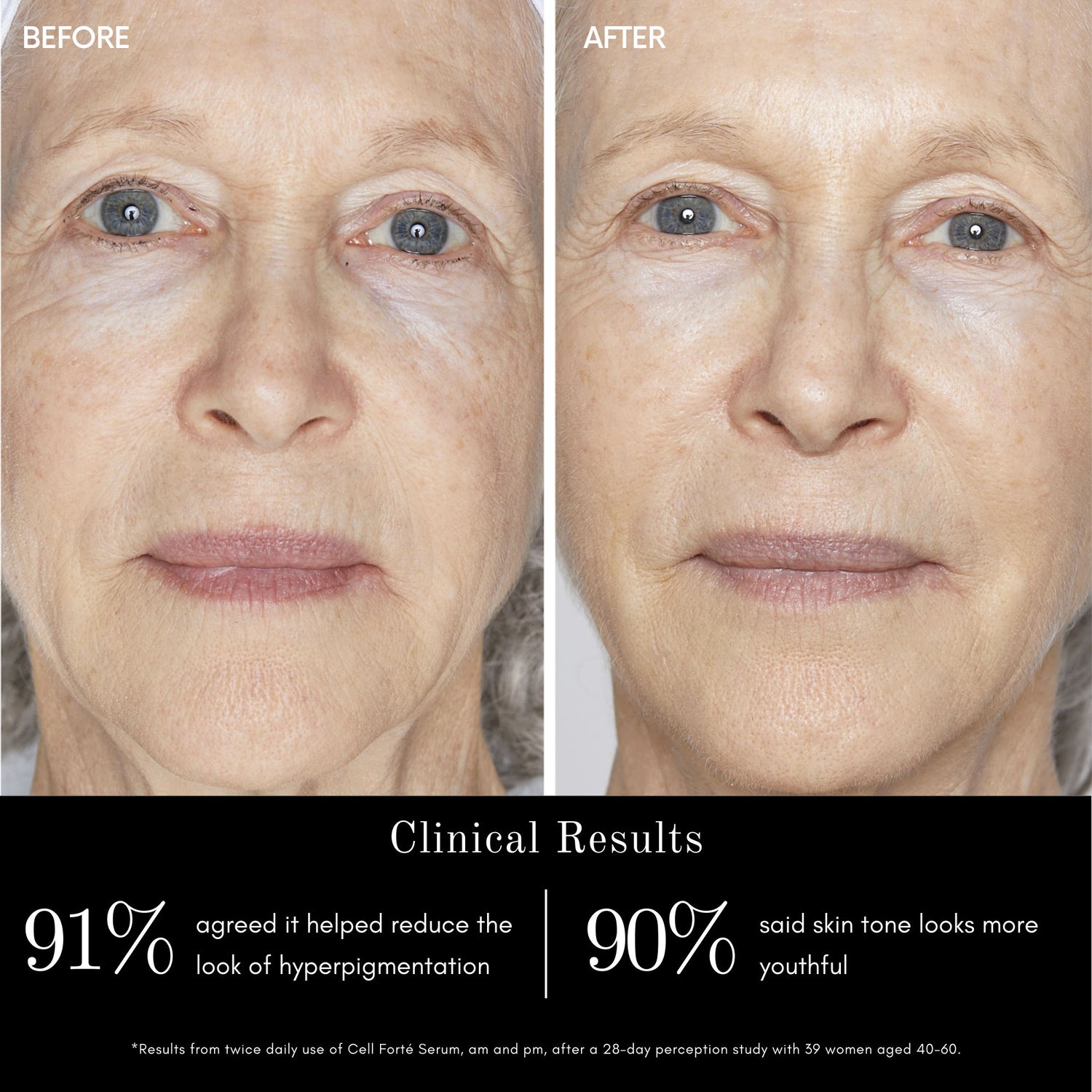 Before and after results of using Angela Caglia Skincare Cell Forté Serum with BIOMSC™