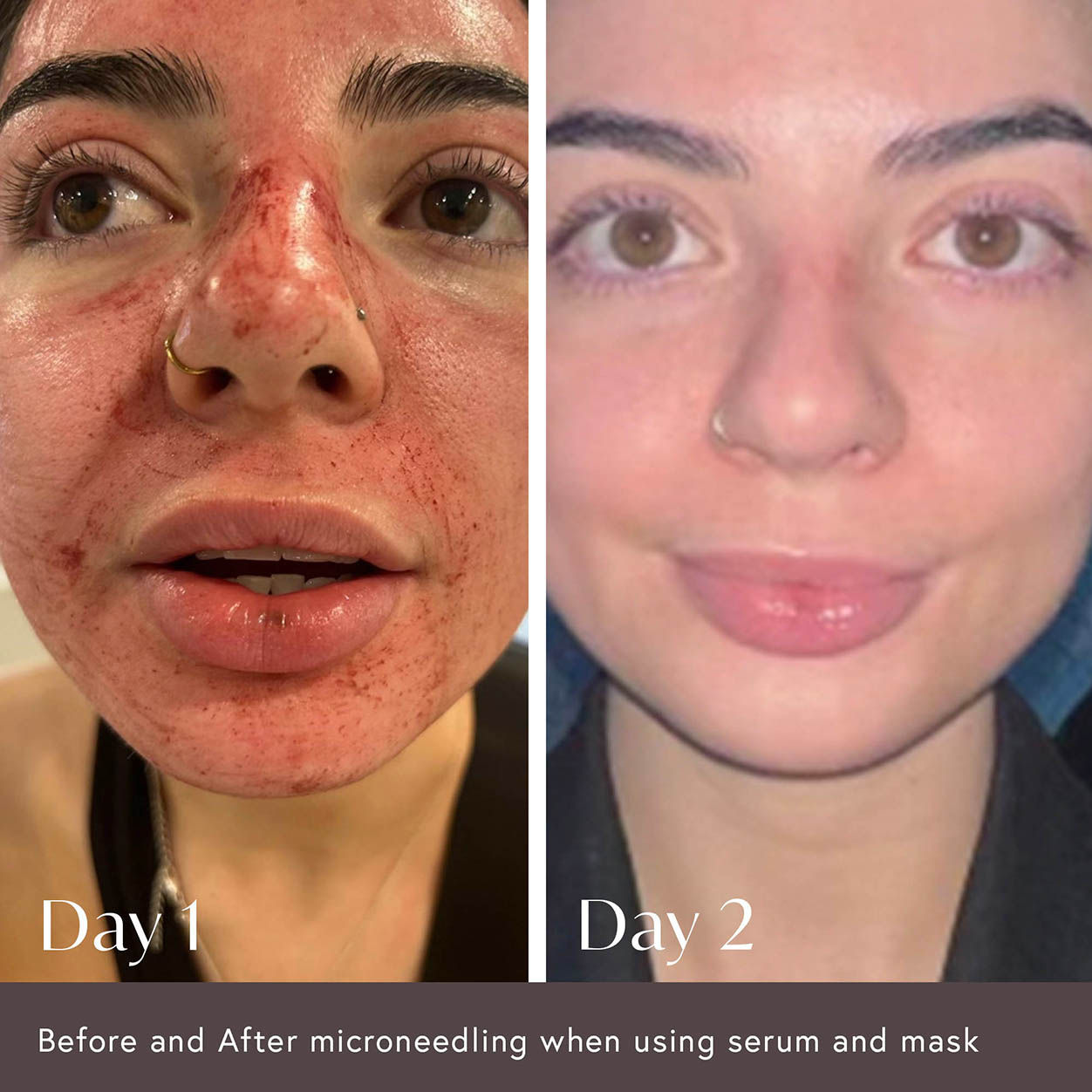 Before and after results of using Viktor Michael Hidden Agenda Pre and Post Injection Care Serum