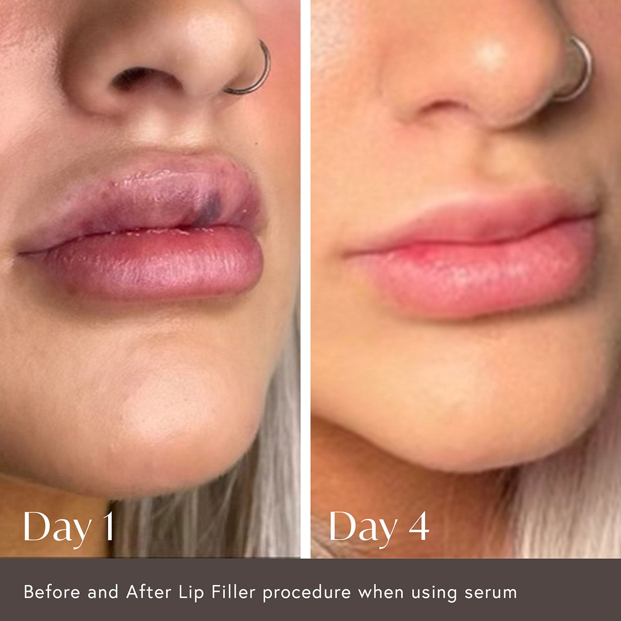 Before and after results of using Viktor Michael Hidden Agenda Pre and Post Injection Care Serum