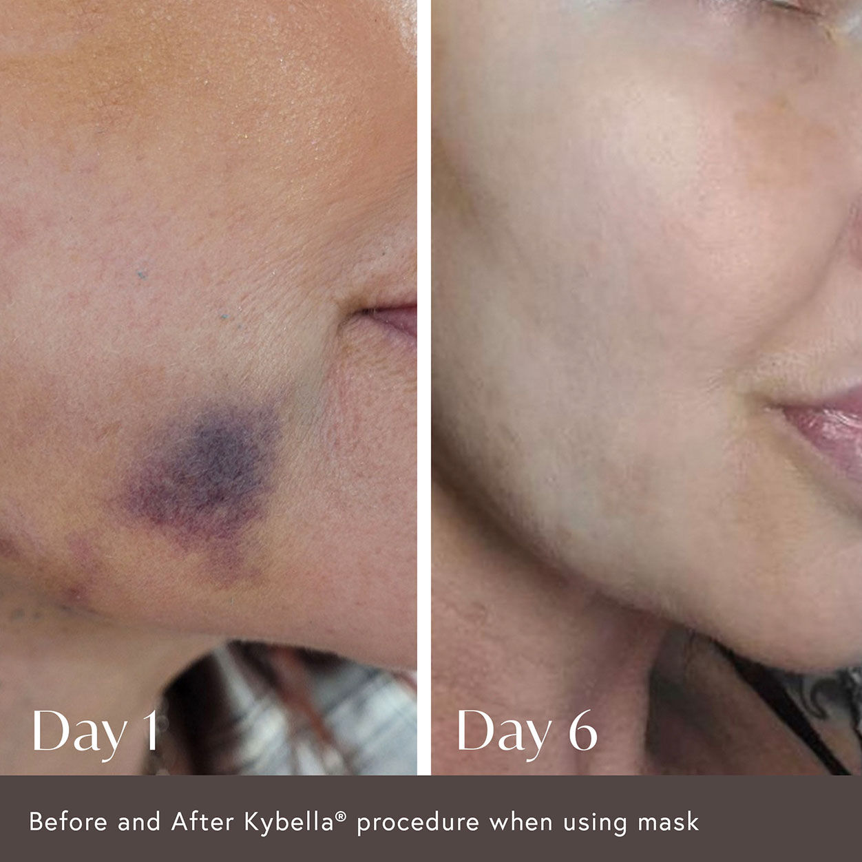 Before and after results of using Viktor Michael Ciao For Now Post Injection Care Mask