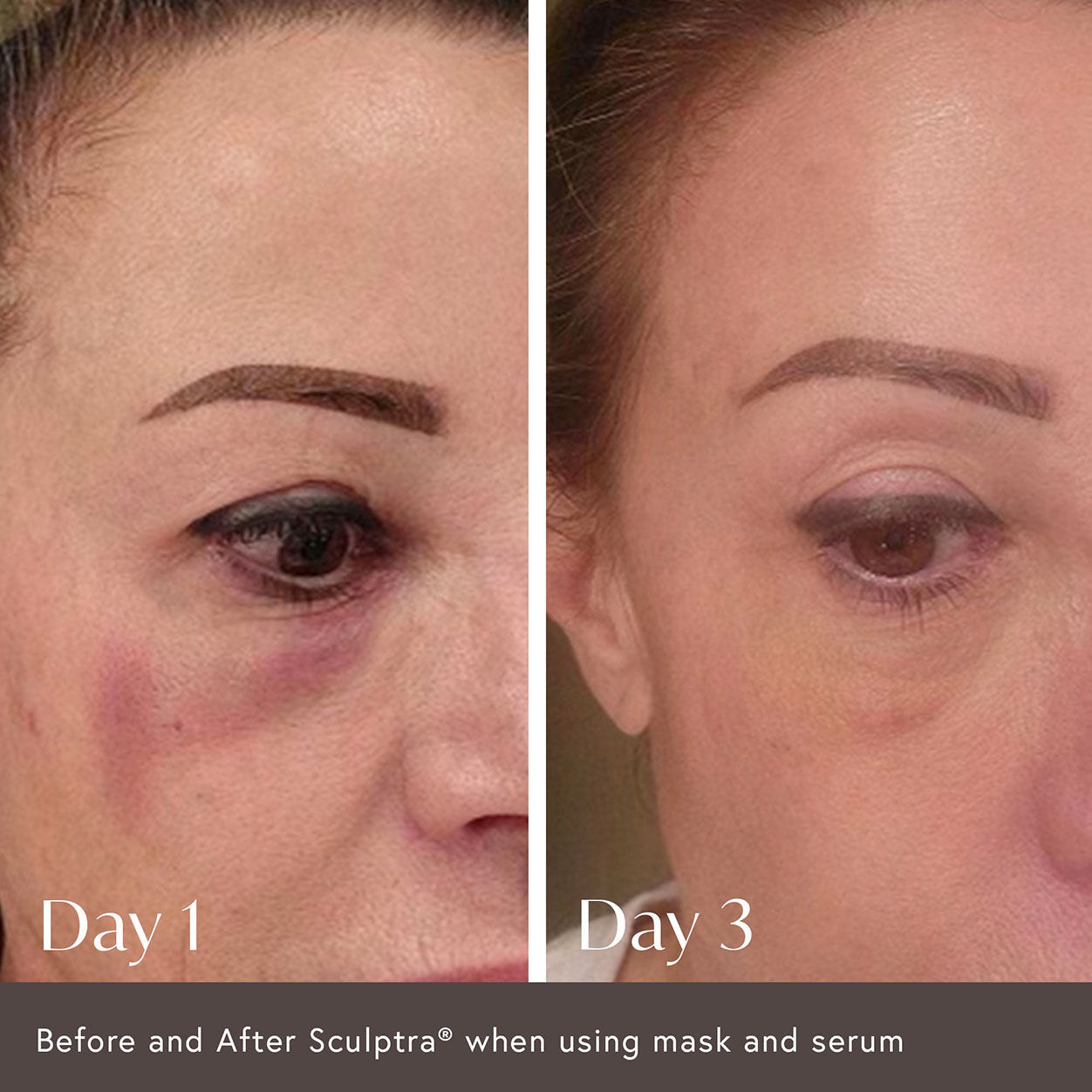 Before and after results of using Viktor Michael Ciao For Now Post Injection Care Mask