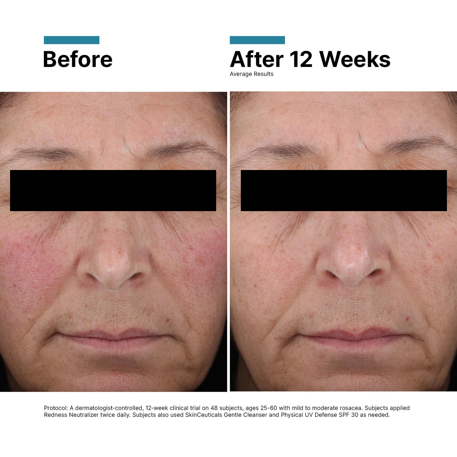 Before and after results of using SkinCeuticals Redness Neutralizer