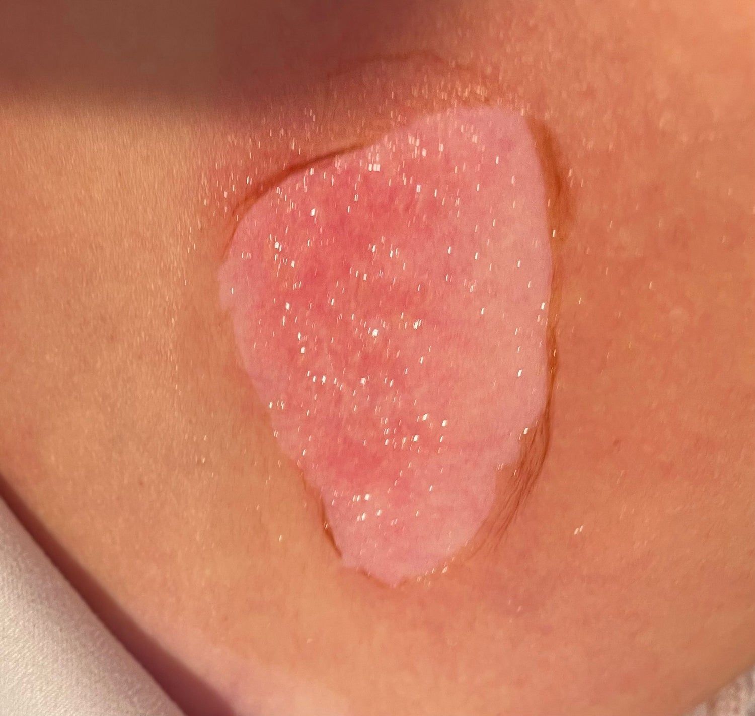 Before and after results of using Tronque Scar Concentrate