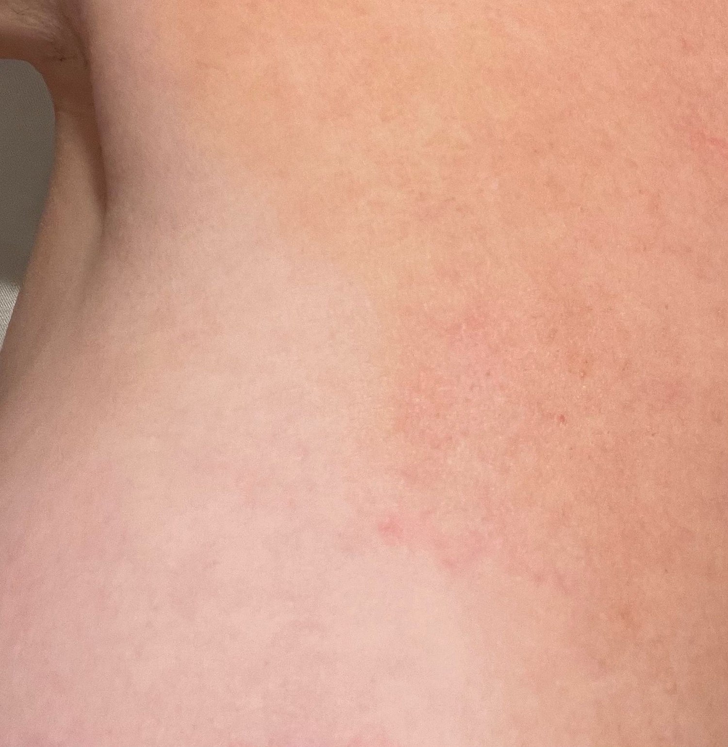 Before and after results of using Tronque Scar Concentrate