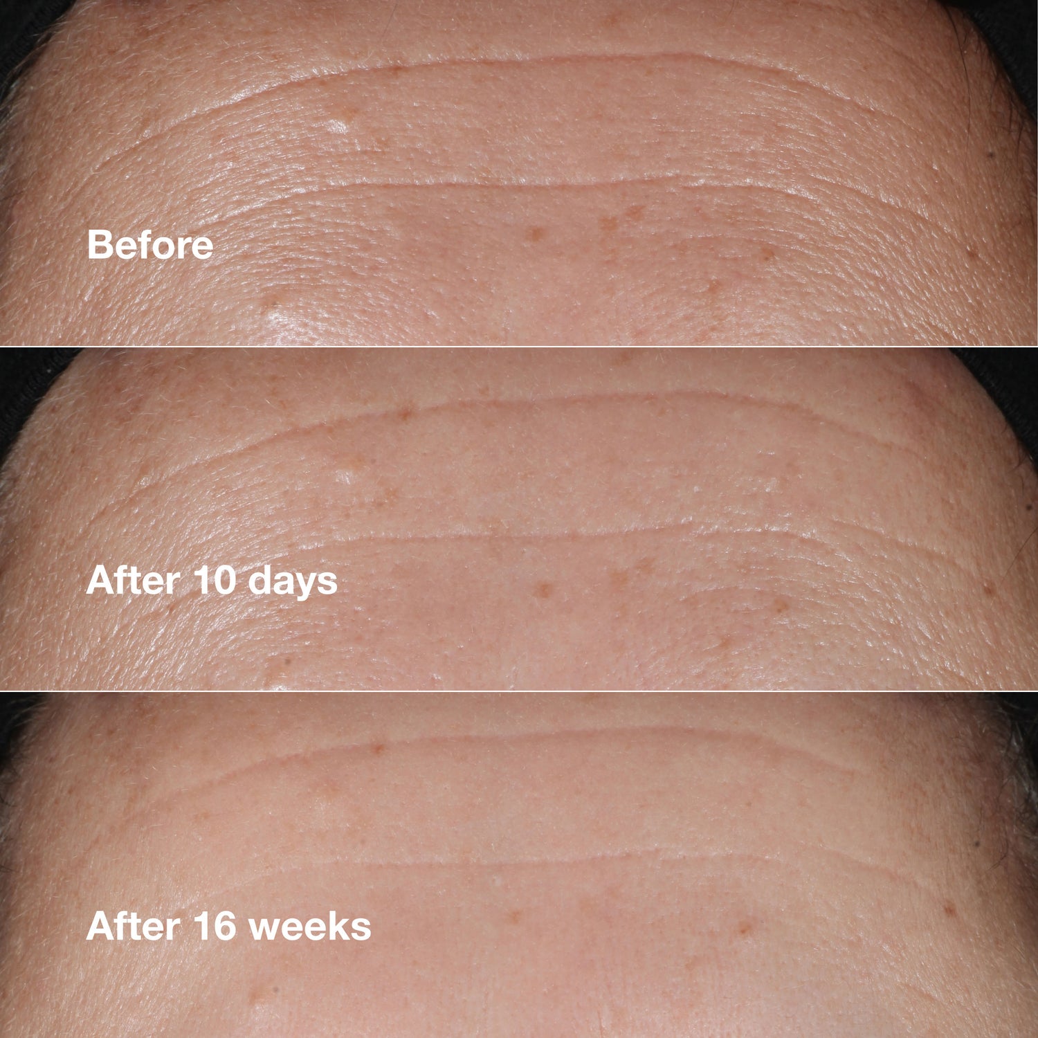 Before and after results of using Clinique Smart Clinical Repair Wrinkle Correcting Serum variant: 1 oz