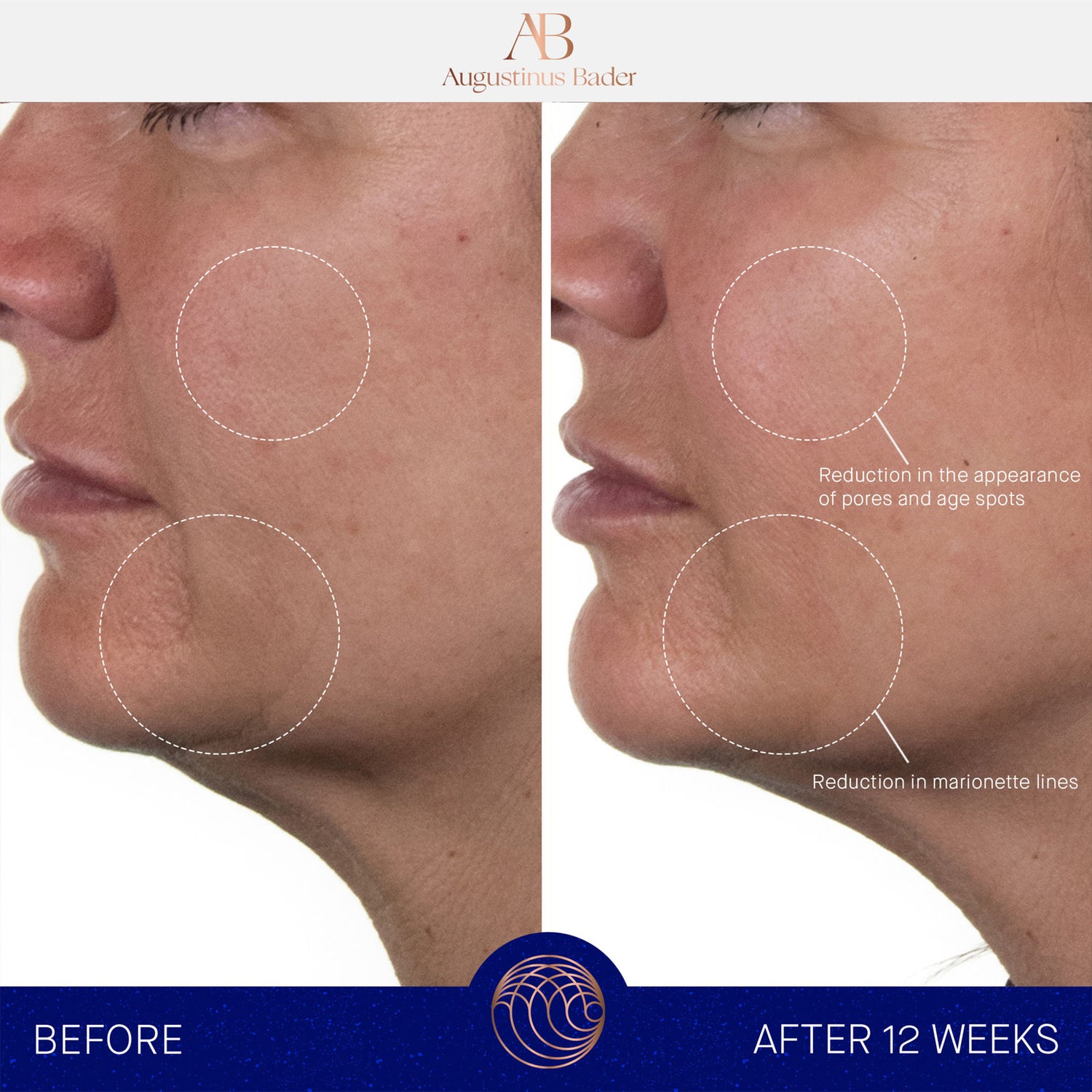 Before and after results of using Augustinus Bader The Rich Cream variant: 1 fl oz