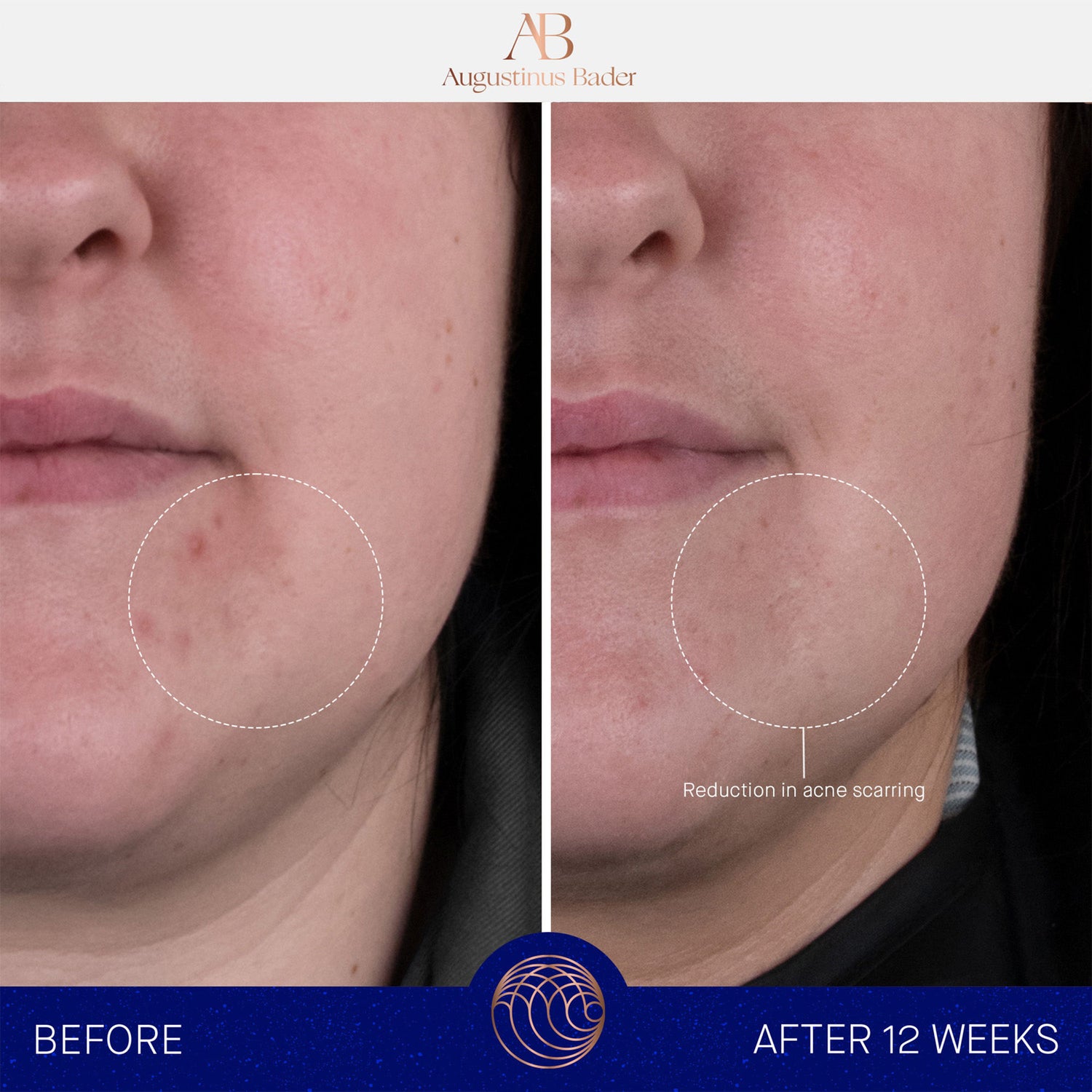 Before and after results of using Augustinus Bader The Rich Cream variant: 1 fl oz