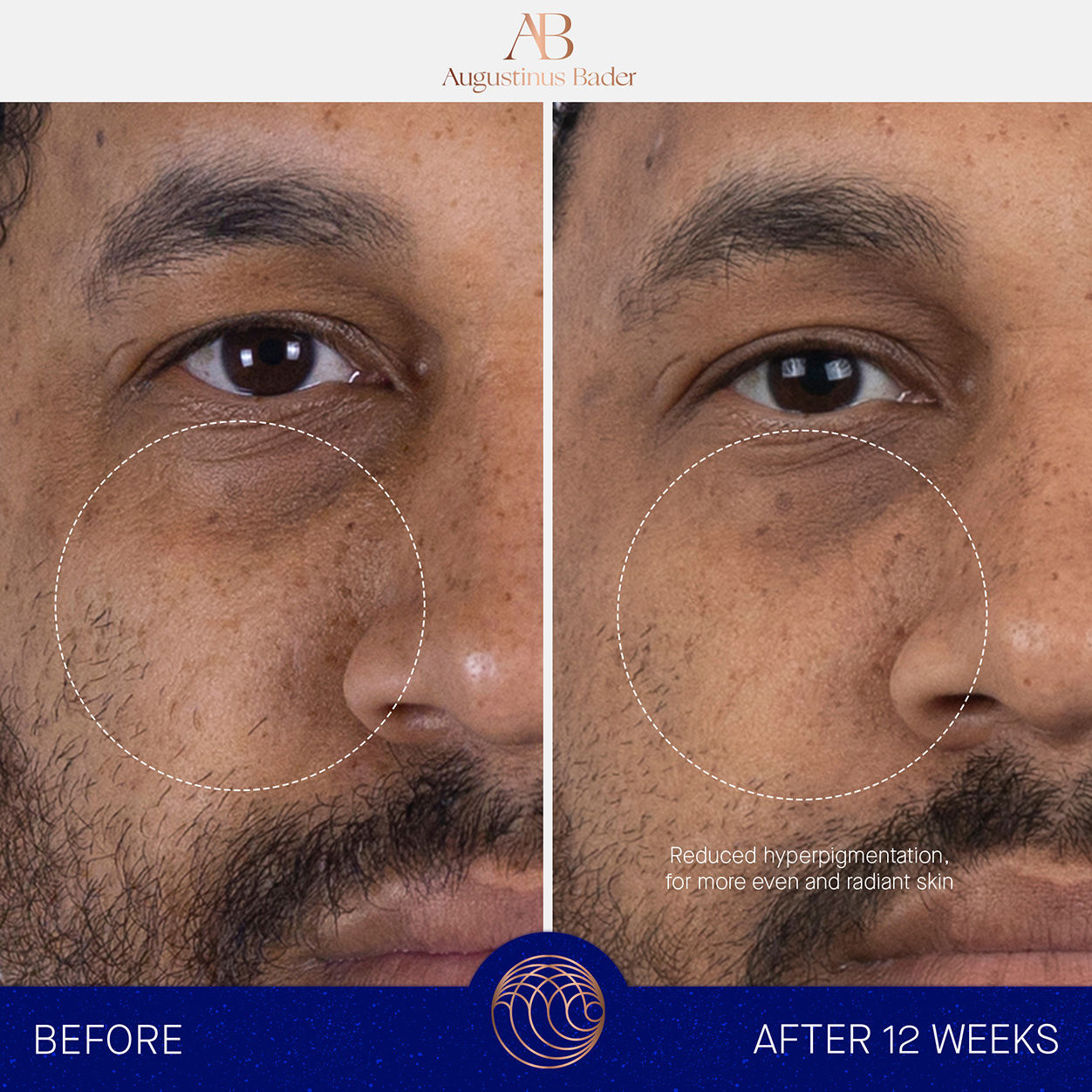 Before and after results of using Augustinus Bader The Serum variant: 1.7 fl oz
