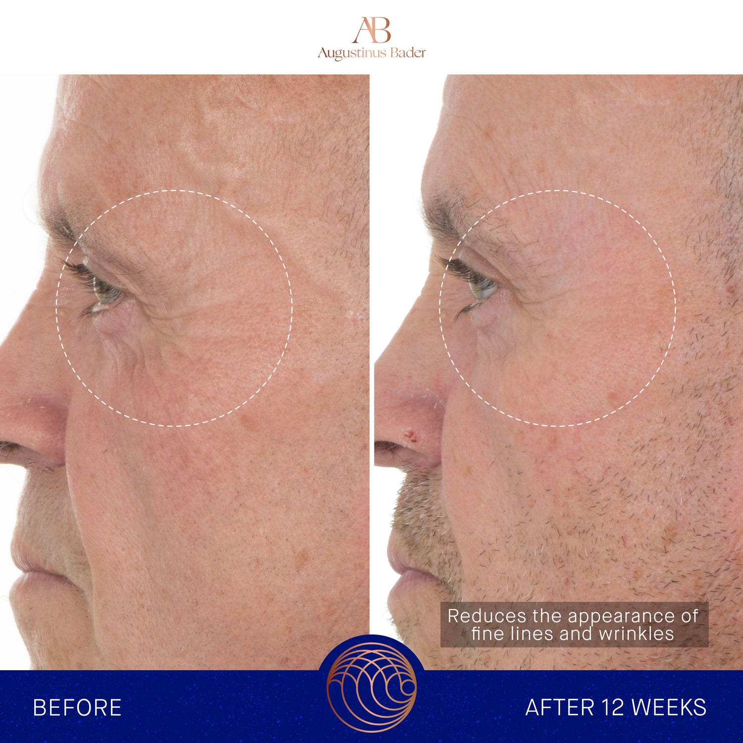 Before and after results of using Augustinus Bader The Retinol Serum variant: 1.7 oz