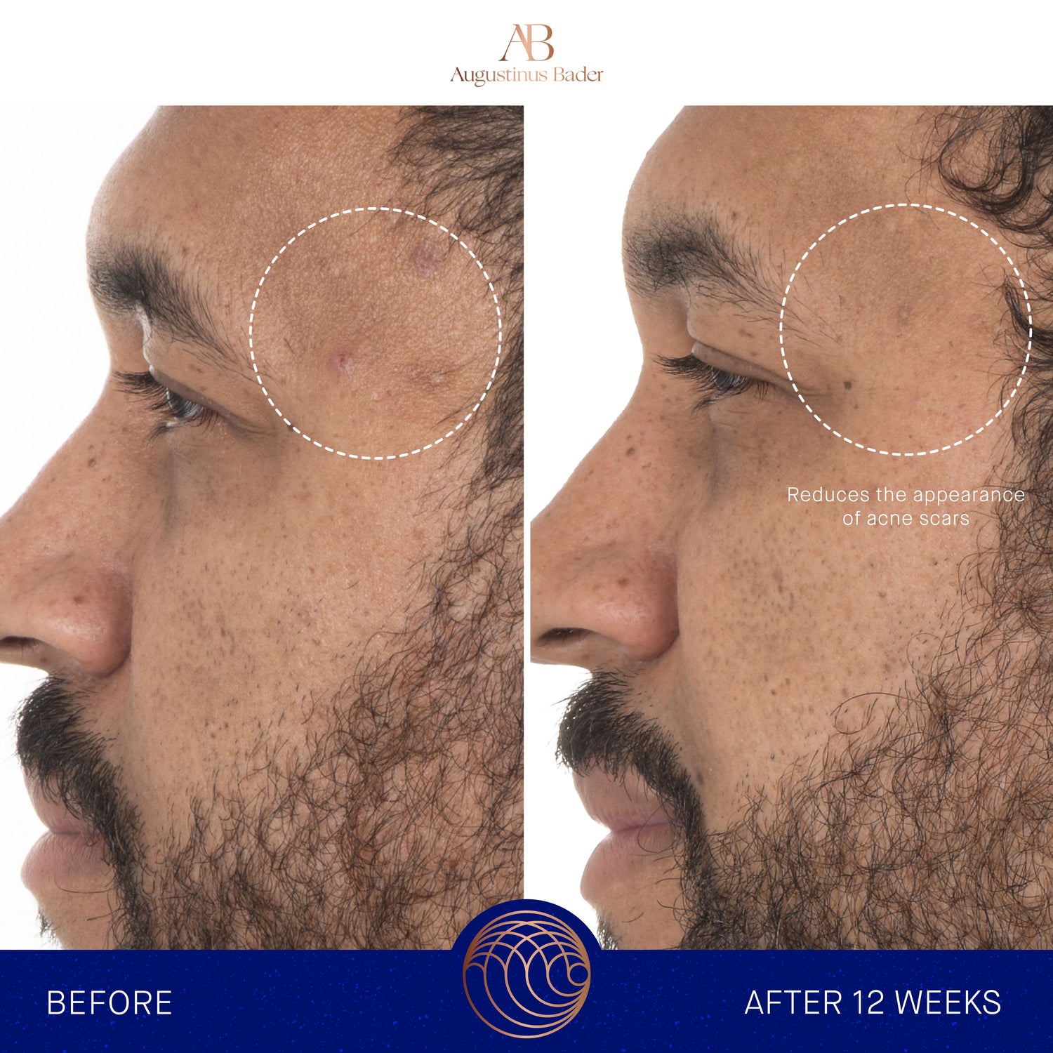 Before and after results of using Augustinus Bader The Retinol Serum variant: 1.7 oz