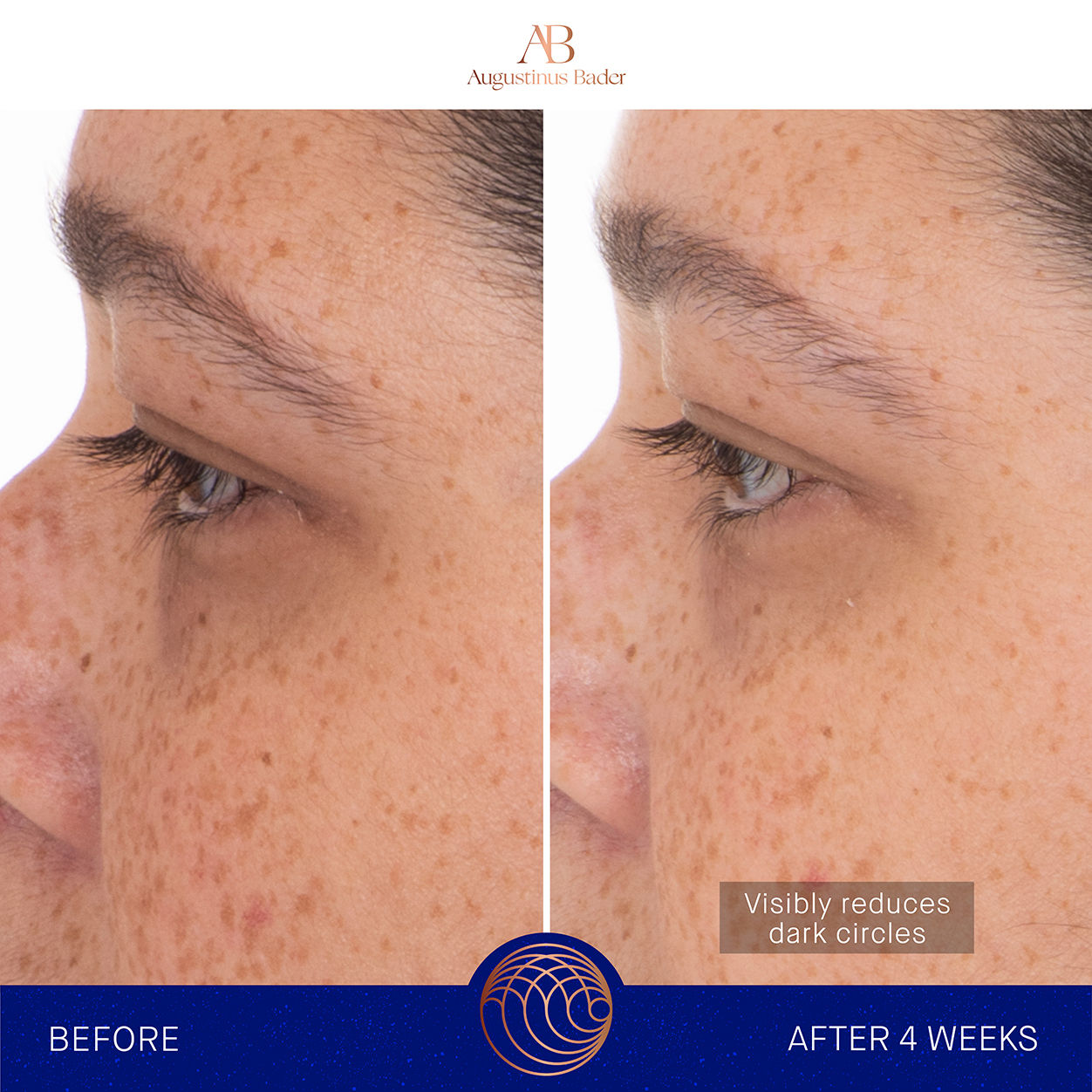 Before and after results of using Augustinus Bader The Eye Patches variant: 1 Treatment