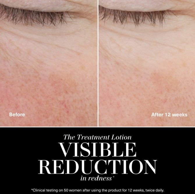 Before and after results of using La Mer The Treatment Lotion variant: 3.4 oz