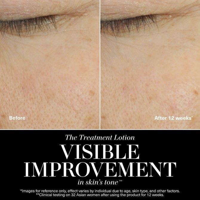 Before and after results of using La Mer The Treatment Lotion variant: 3.4 oz