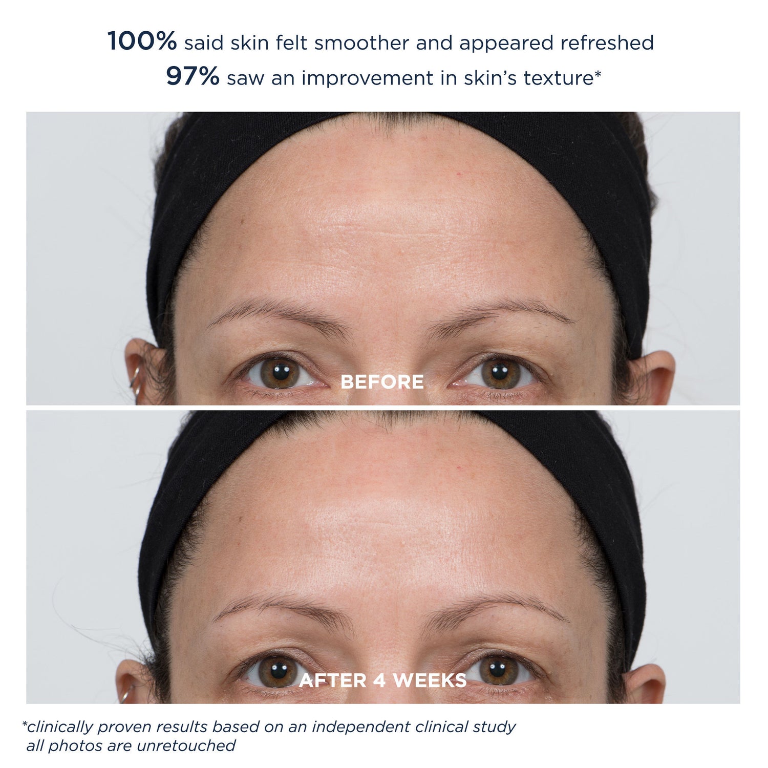 Before and after results of using M-61 PowerGlow Peel Extra Strength 20% variant: 8 Treatments