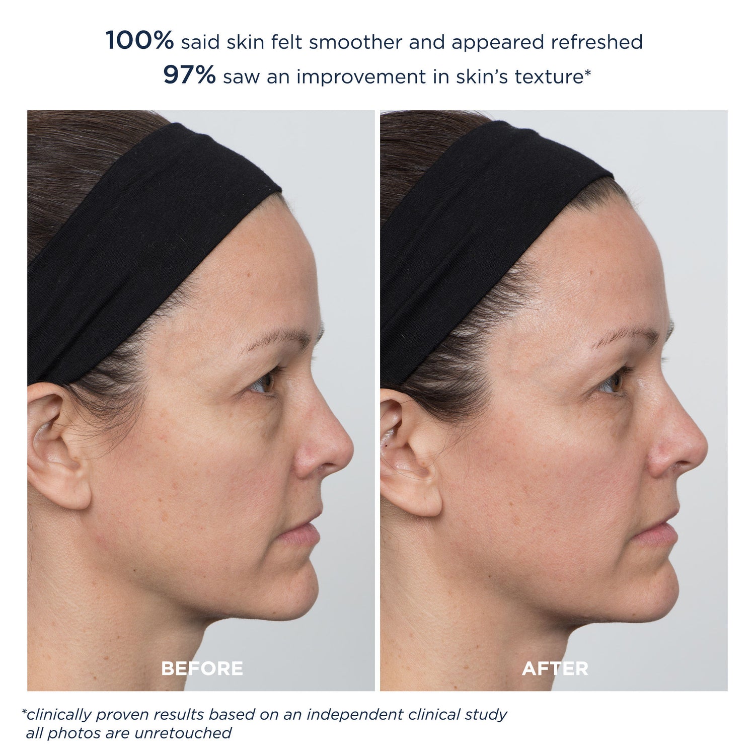 Before and after results of using M-61 PowerGlow Peel Extra Strength 20% variant: 8 Treatments