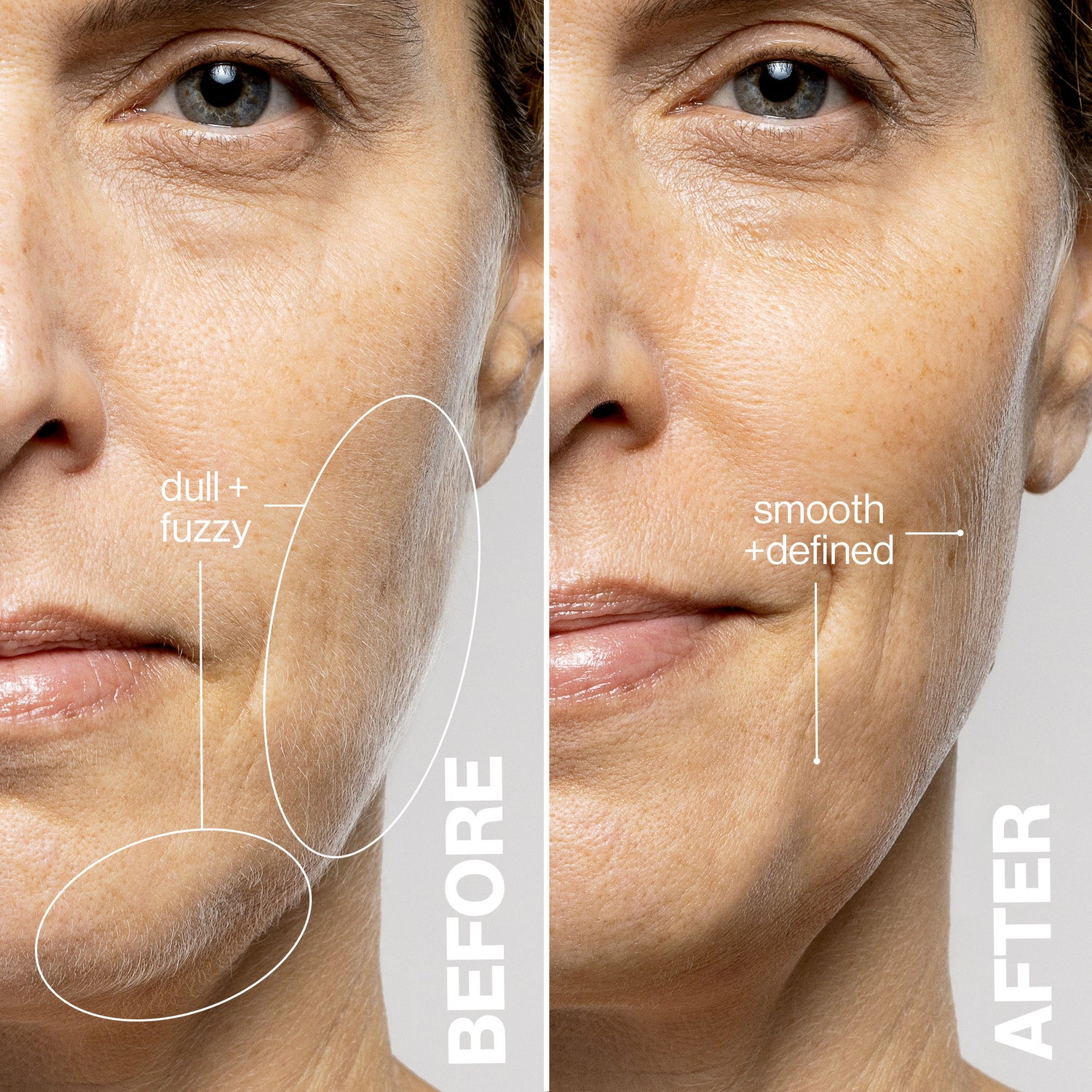 Before and after results of using Dermaflash Luxe+ variant: Blush