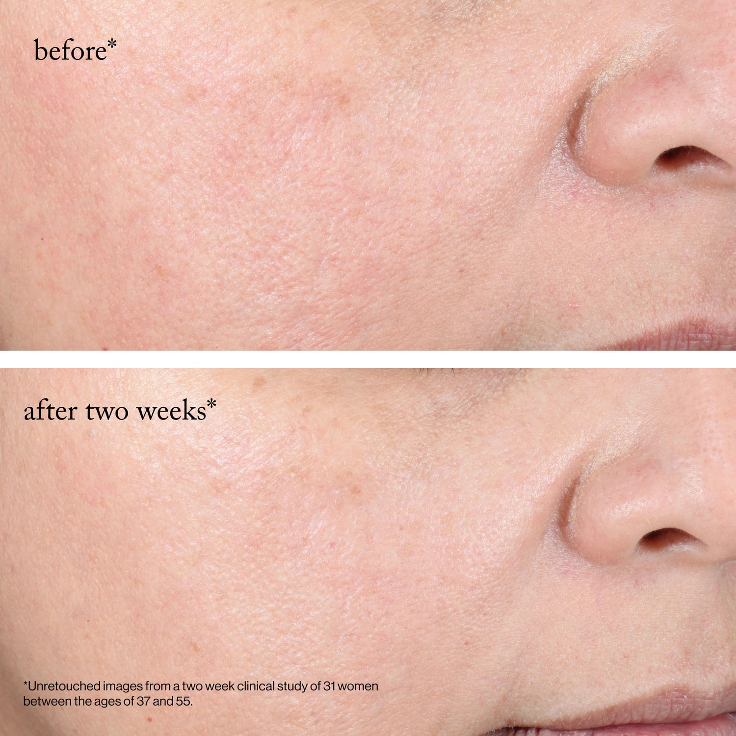 Before and after results of using Goop Beauty 15% Glycolic Acid Overnight Glow Peel