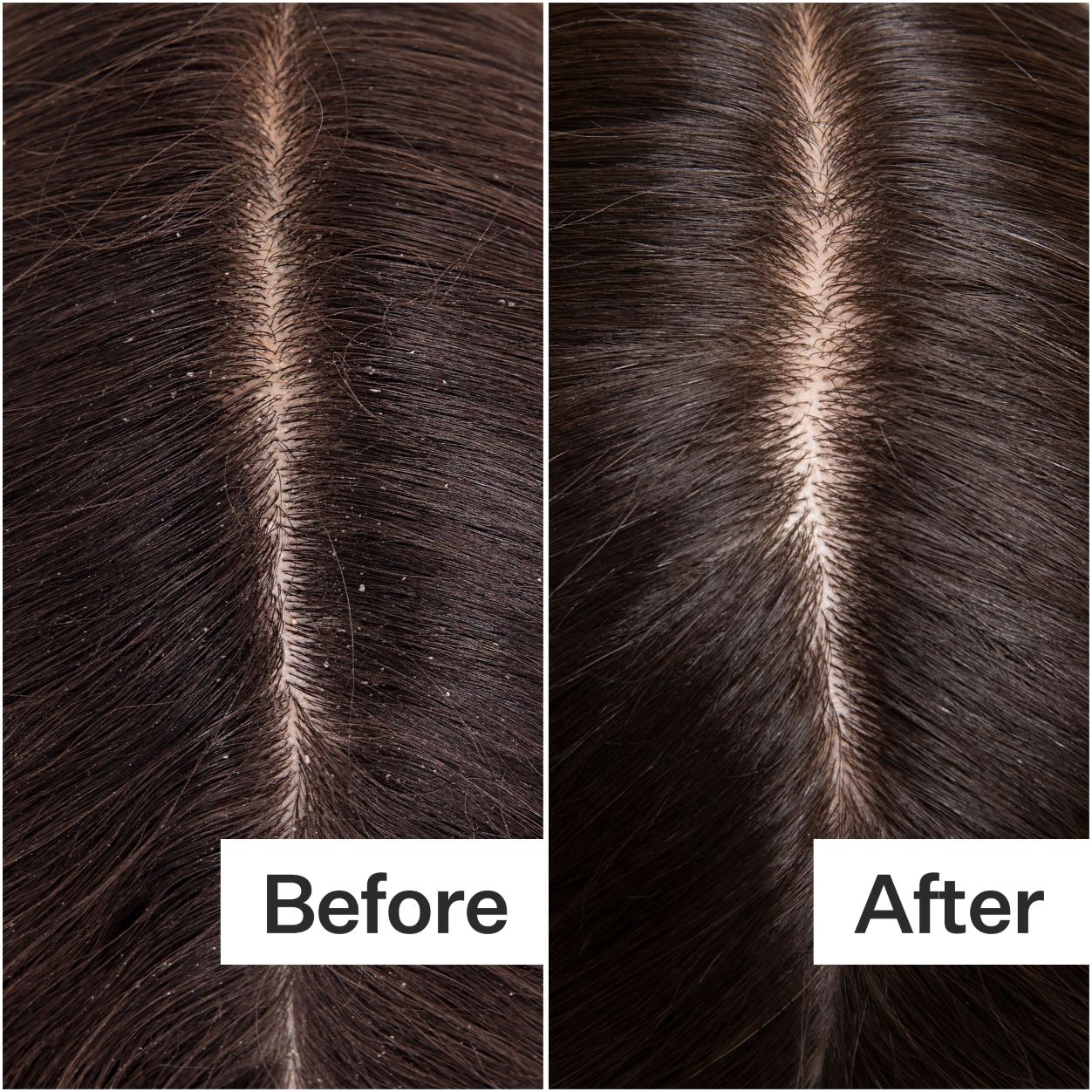 Before and after results of using Act+Acre Cold Processed Hair Cleanse Shampoo variant: 10 fl oz
