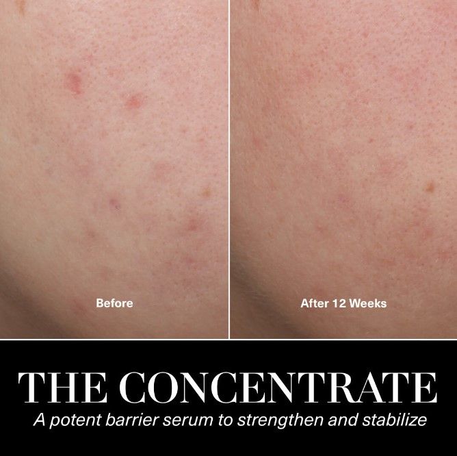Before and after results of using La Mer The Concentrate variant: 0.5 oz