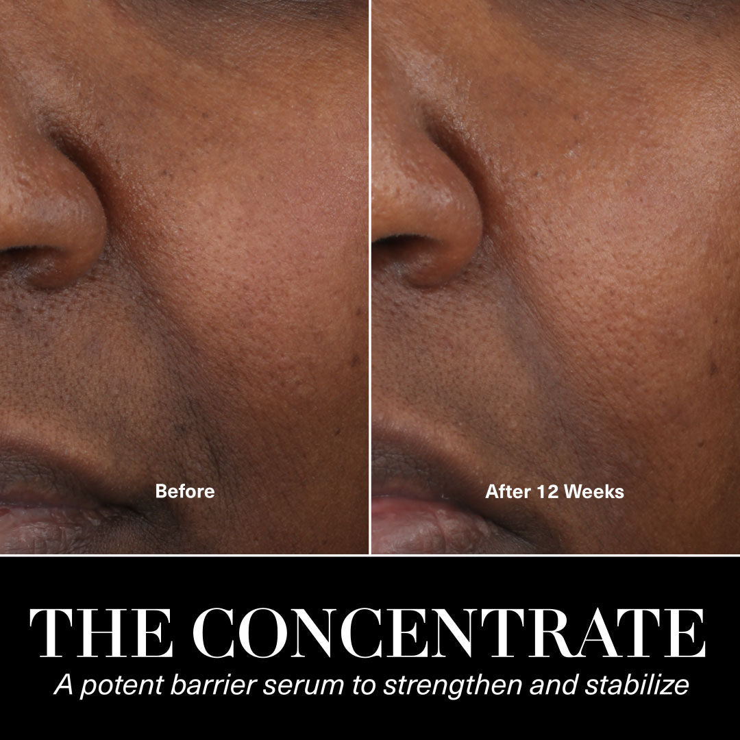 Before and after results of using La Mer The Concentrate variant: 0.5 oz