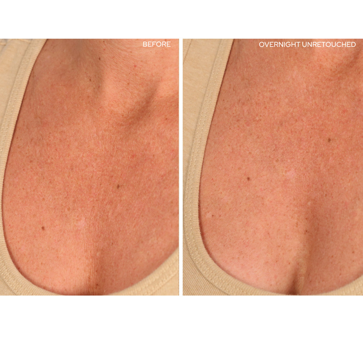 Before and after results of using SIO ChestLift variant: 1 Treatment