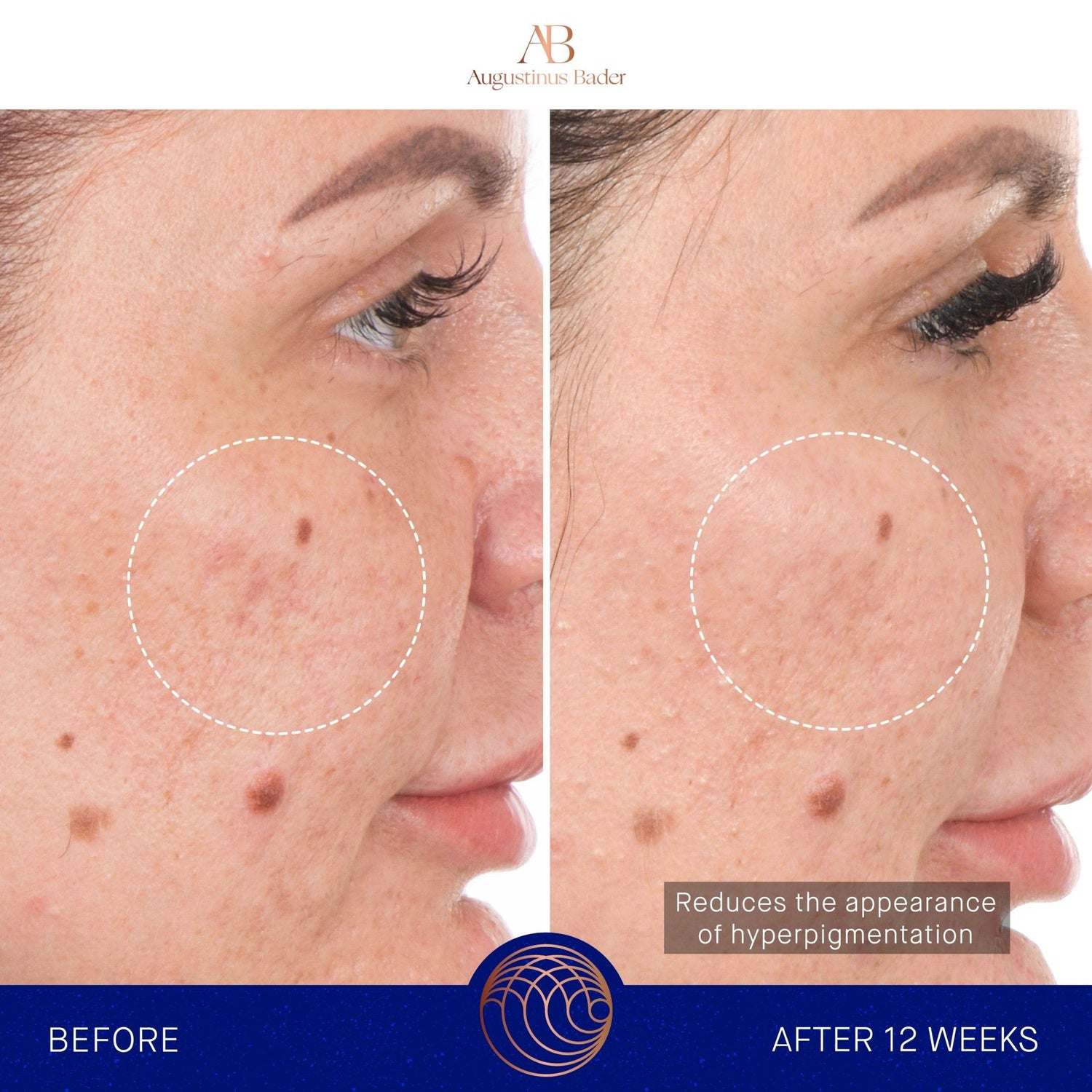 Before and after results of using Augustinus Bader The Retinol Serum variant: 1 oz