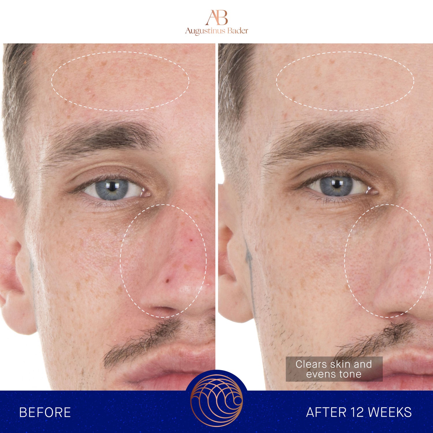 Before and after results of using Augustinus Bader The Retinol Serum variant: 1 oz
