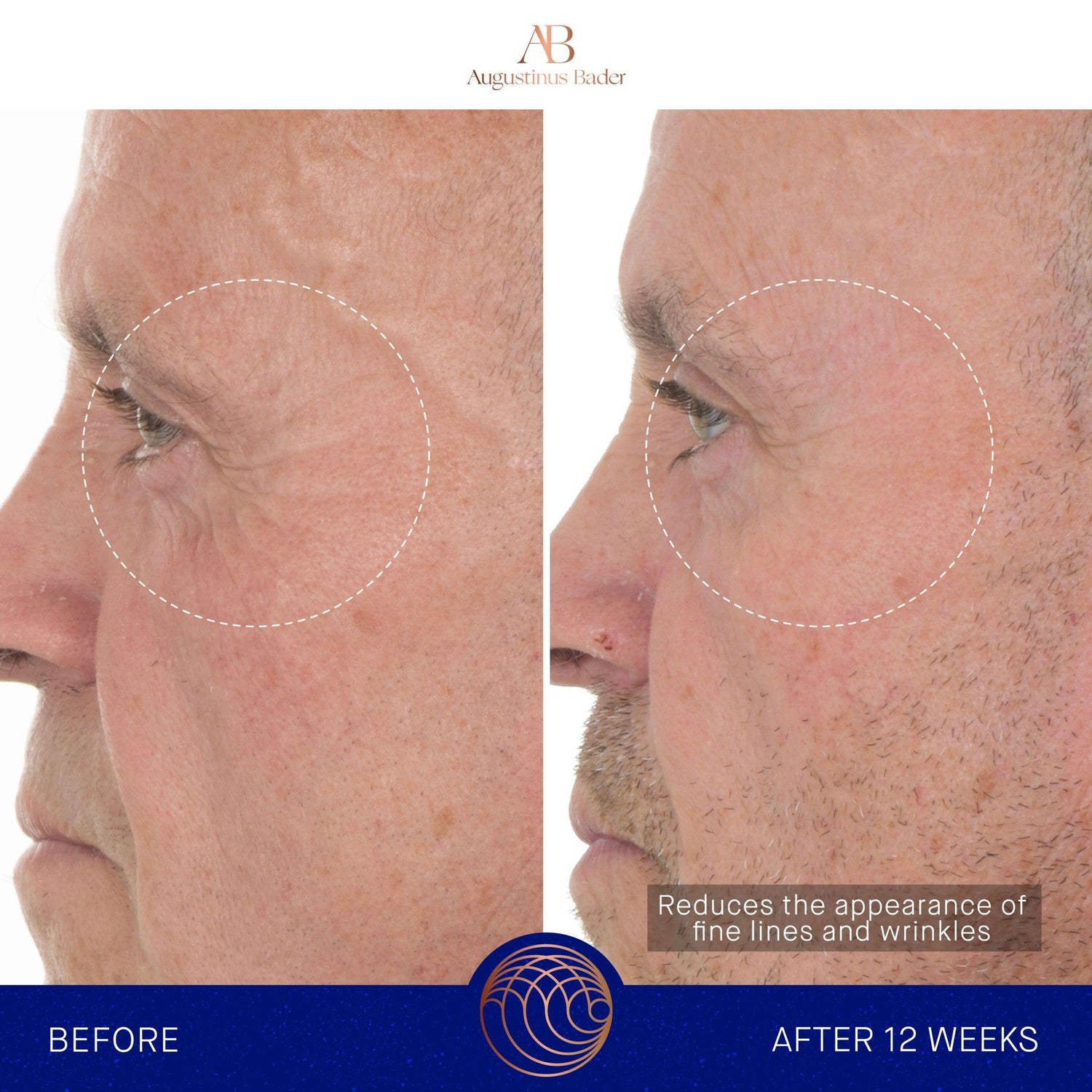 Before and after results of using Augustinus Bader The Retinol Serum variant: 1 oz