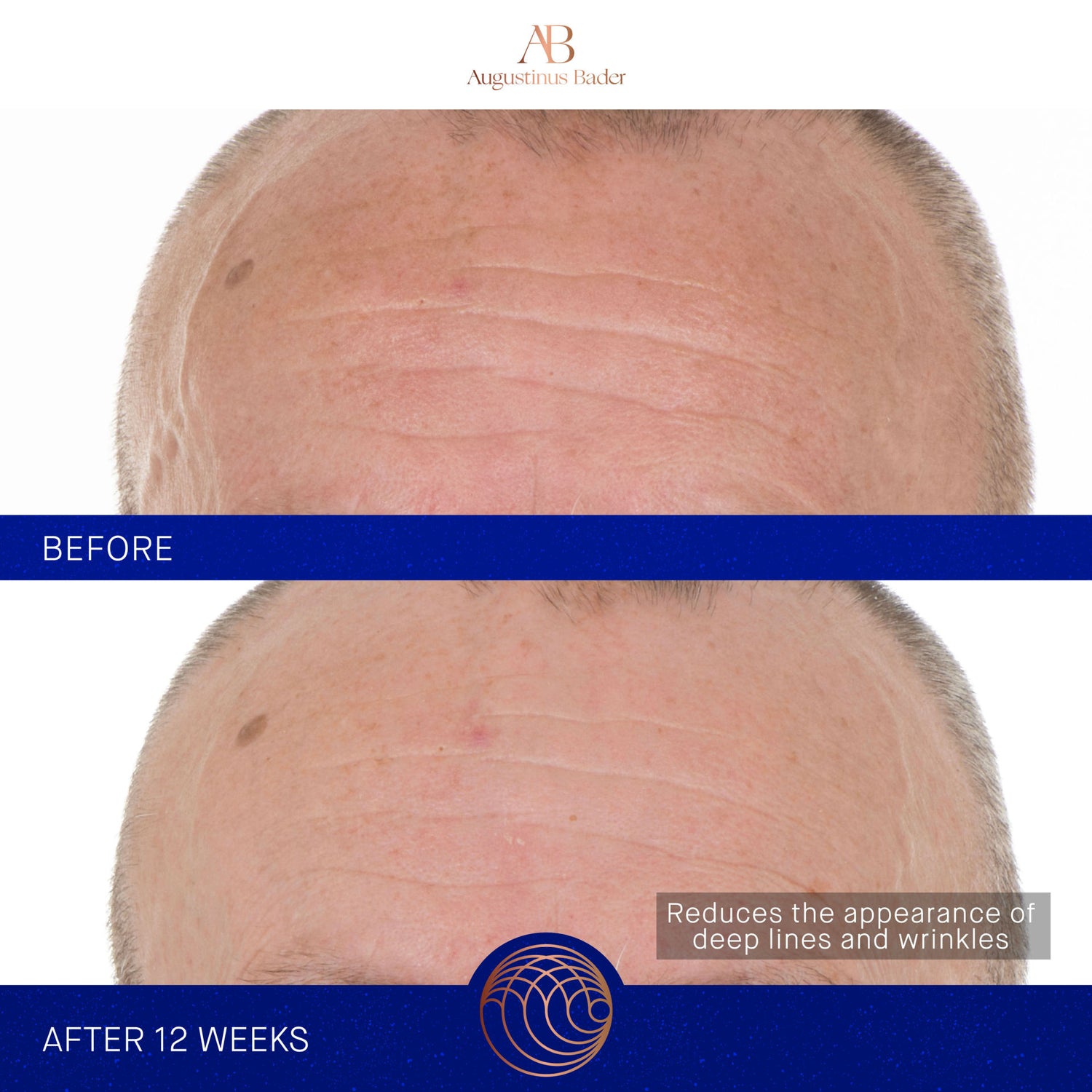 Before and after results of using Augustinus Bader The Retinol Serum variant: 1 oz