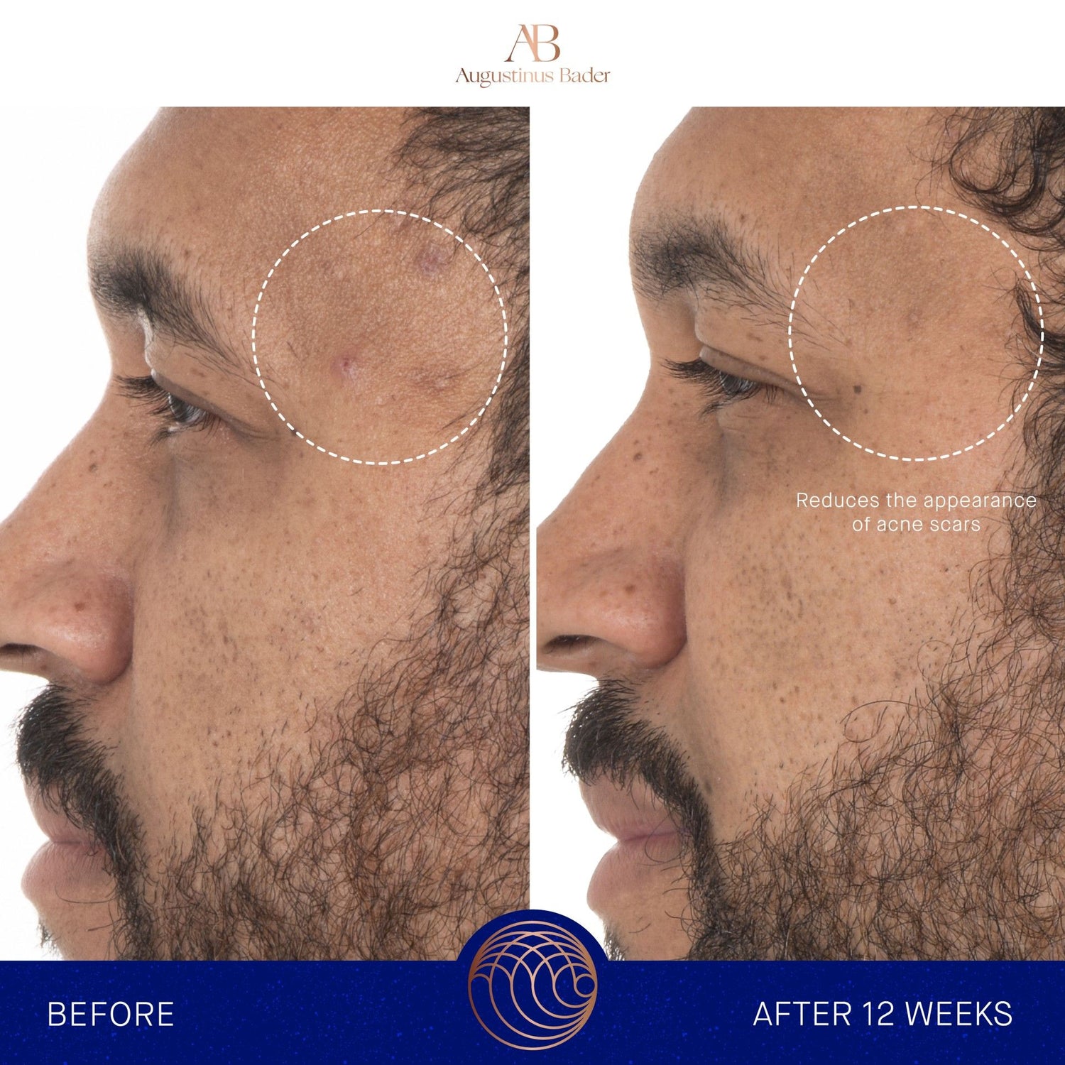 Before and after results of using Augustinus Bader The Retinol Serum variant: 1 oz