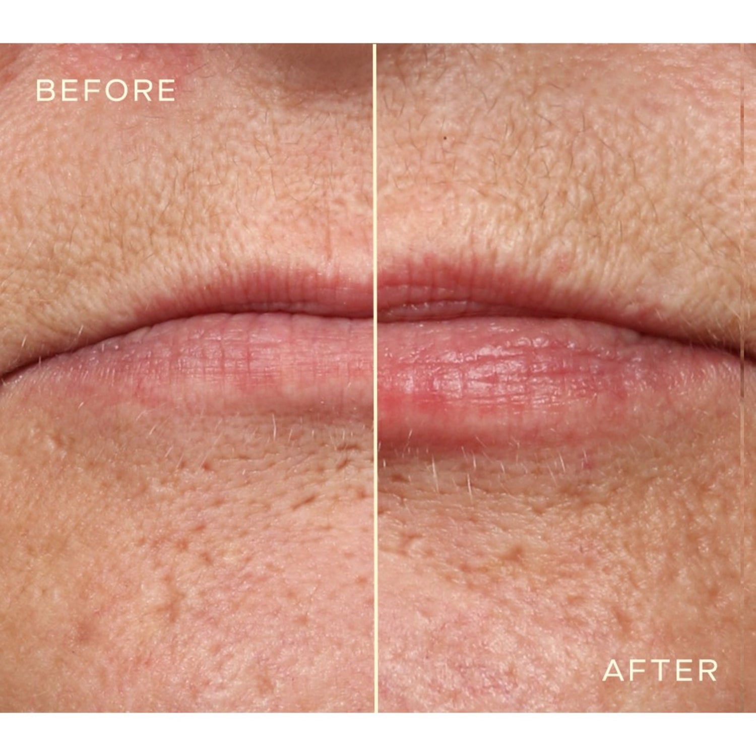 Ourself Lip Filler before and after image .