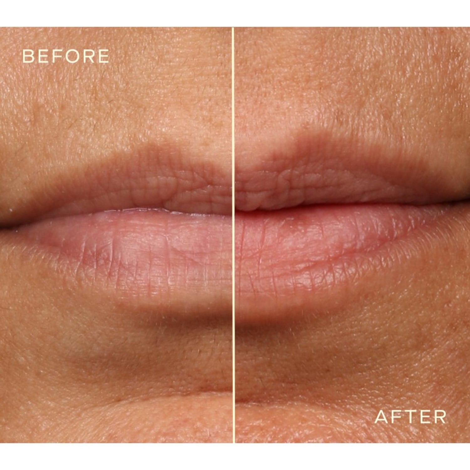 Ourself Lip Filler before and after image 2 .