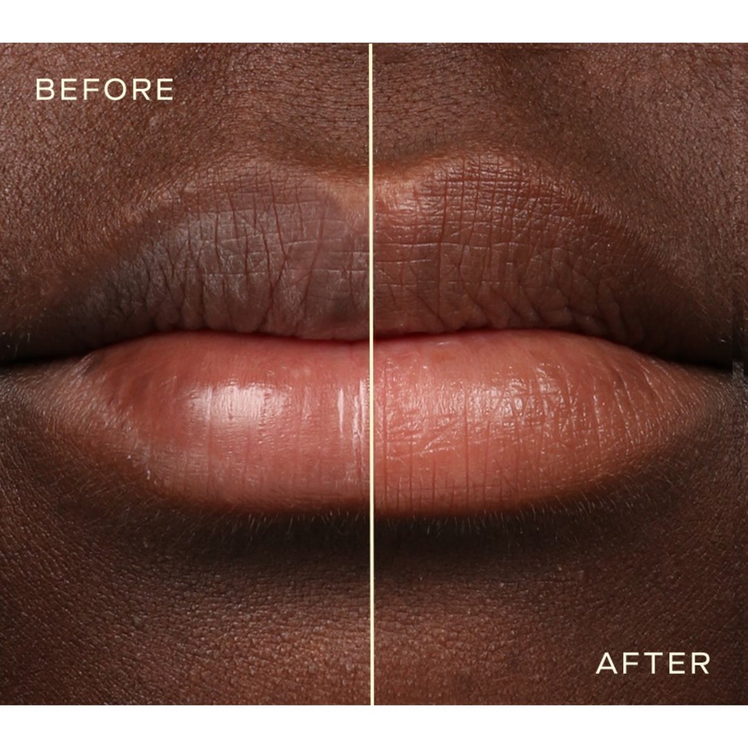 Ourself Lip Filler before and after image 3 .