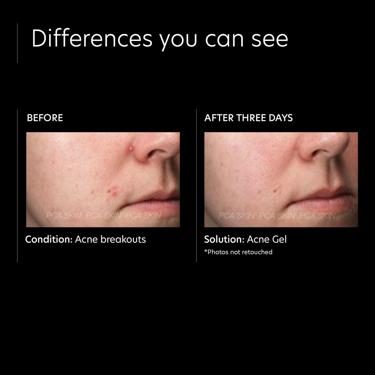 PCA Skin Acne Gel With OmniSome .