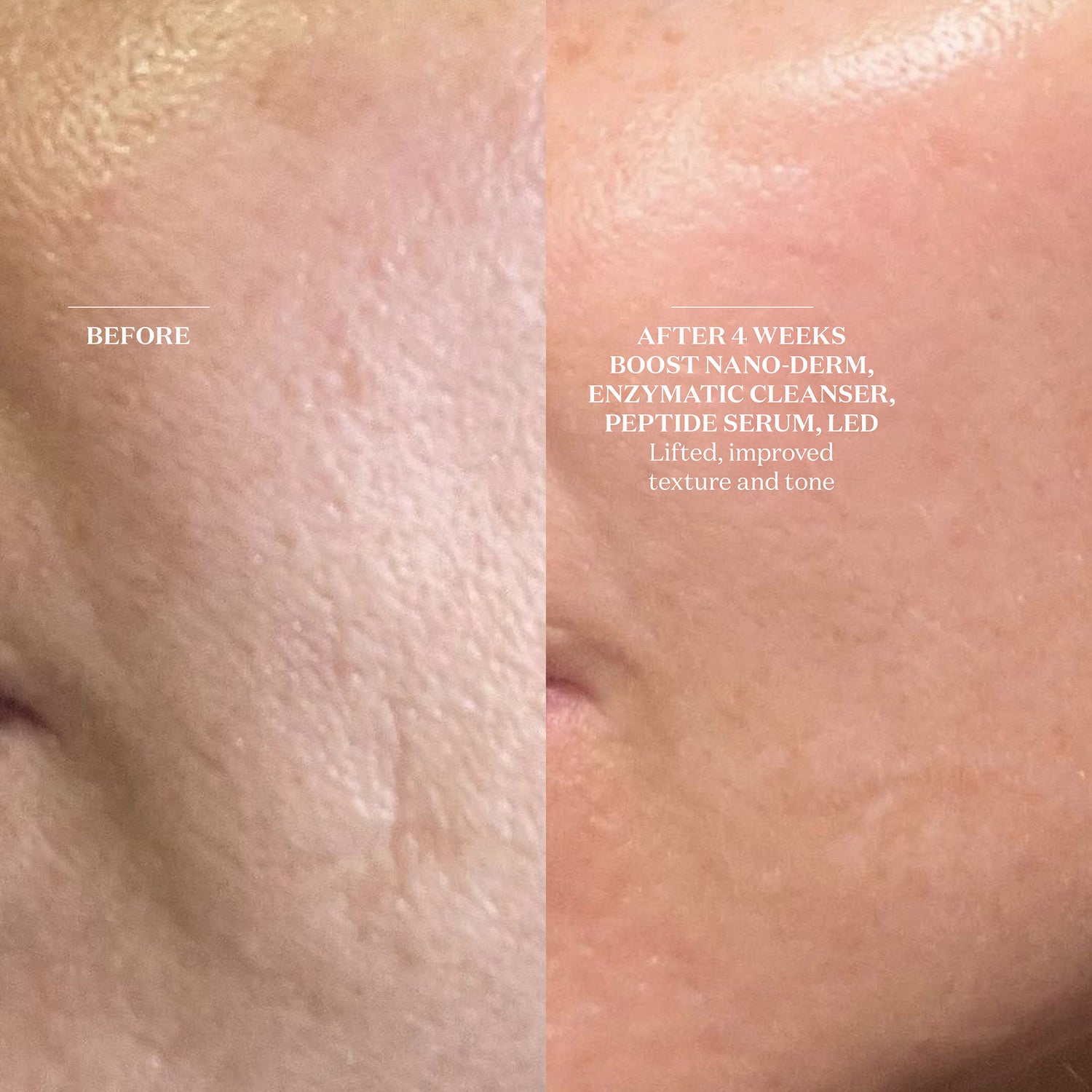 Before and after results of using The Light Salon Boost Nano-Dermabrasion & Nano-Infusion Pen