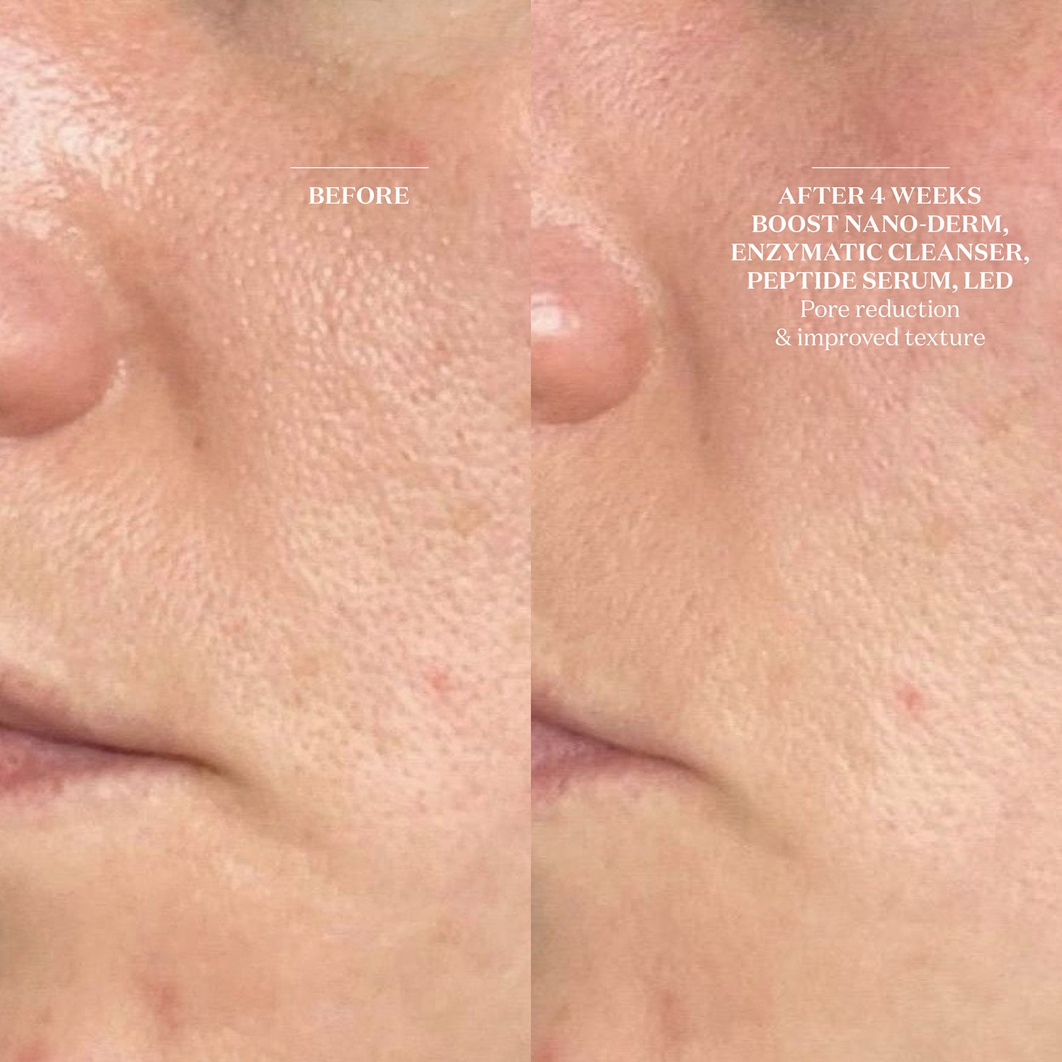 Before and after results of using The Light Salon Boost Nano-Dermabrasion & Nano-Infusion Pen