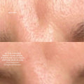 Before and after results of using The Light Salon Boost Nano-Dermabrasion & Nano-Infusion Pen