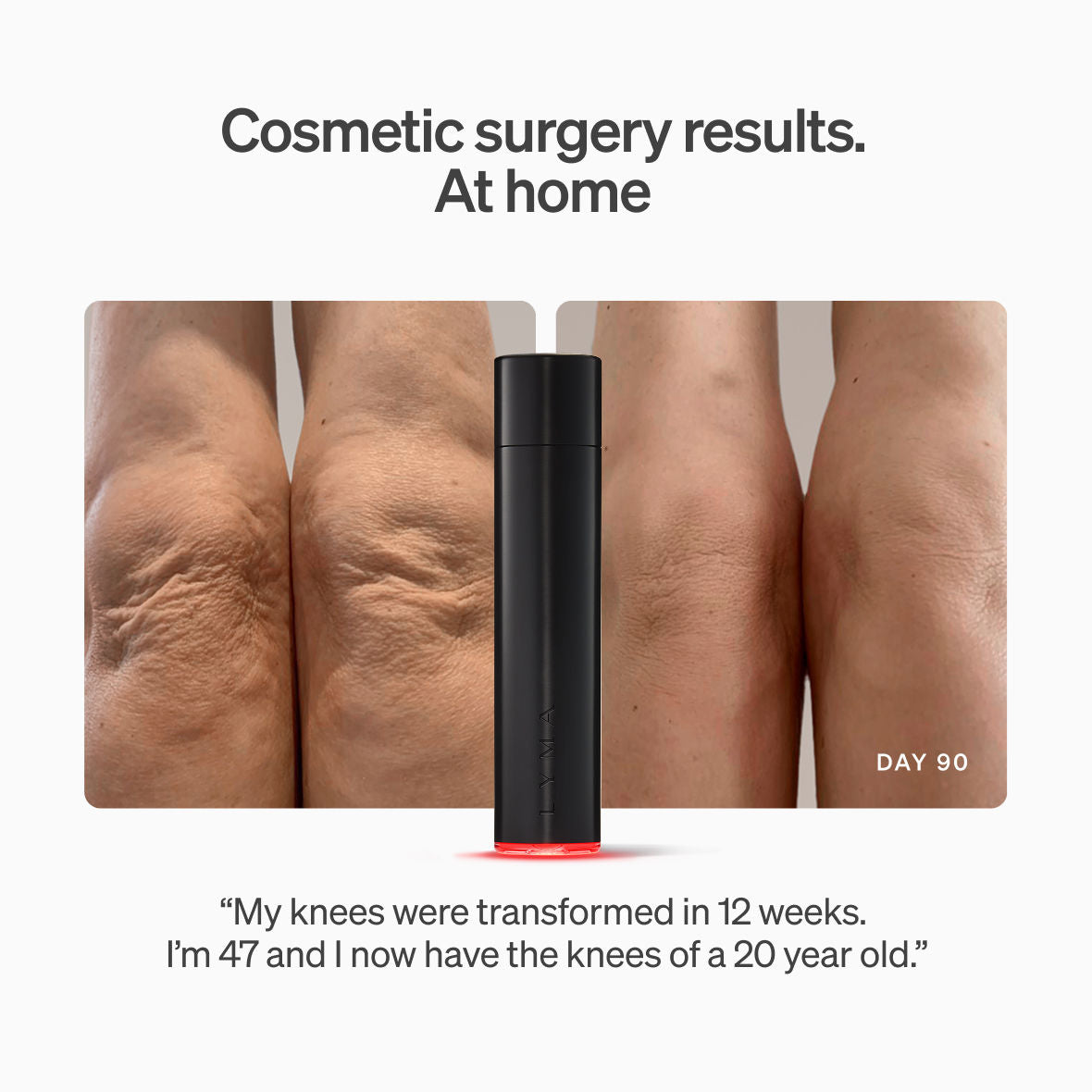 Before and after results of using LYMA LYMA Laser Starter Kit