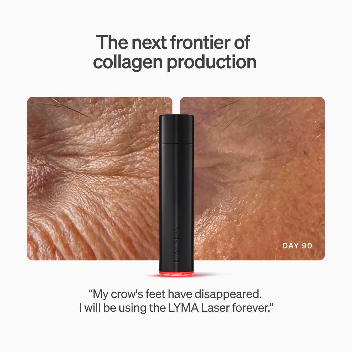 Before and after results of using LYMA LYMA Laser Starter Kit