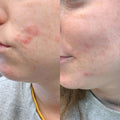 Before and after results of using BalmLabs ClearBalm Serum Hydrator