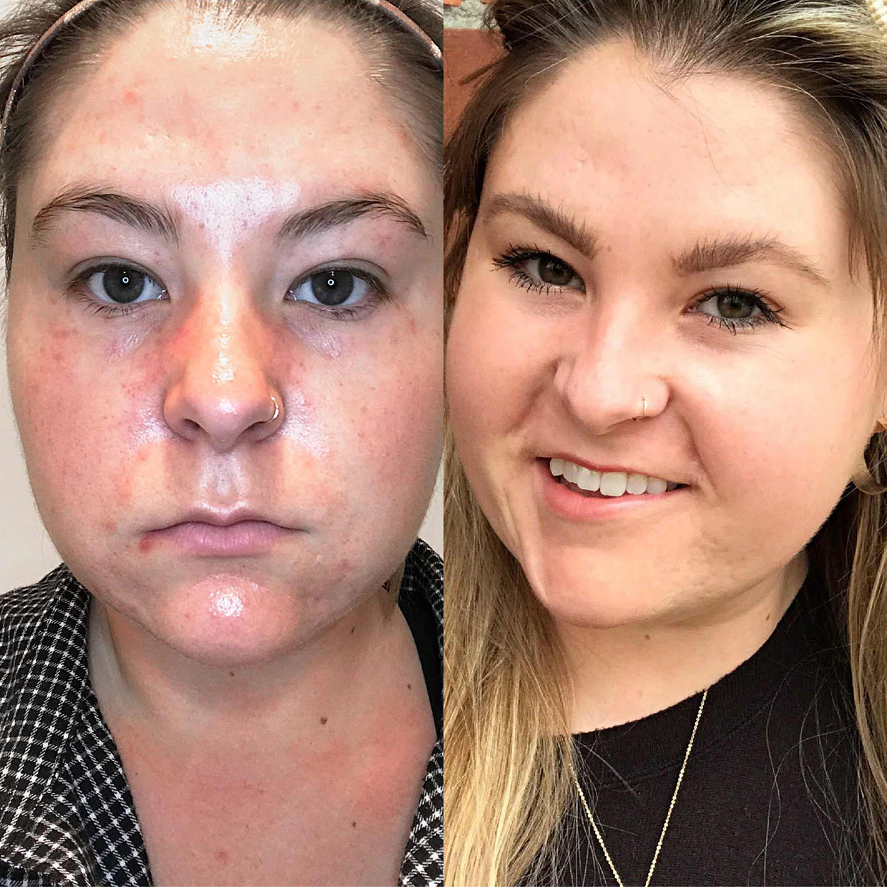 Before and after results of using BalmLabs ClearBalm Serum Hydrator