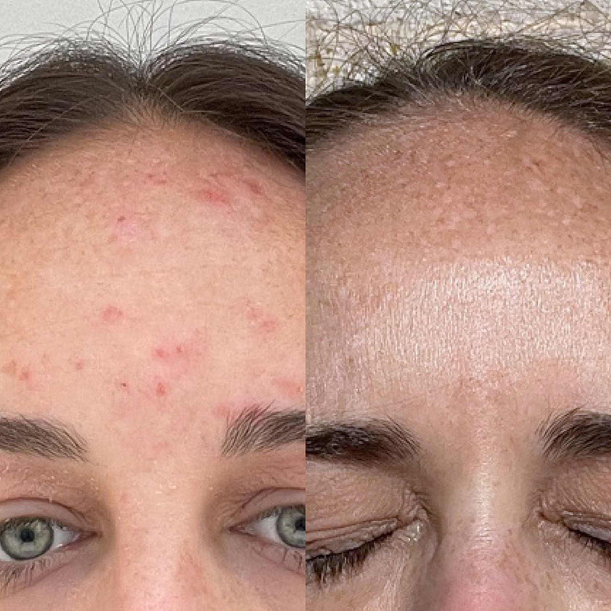 Before and after results of using BalmLabs ClearBalm Power Elixir