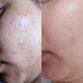 Before and after results of using BalmLabs ClearBalm Gentle Foam Cleanser