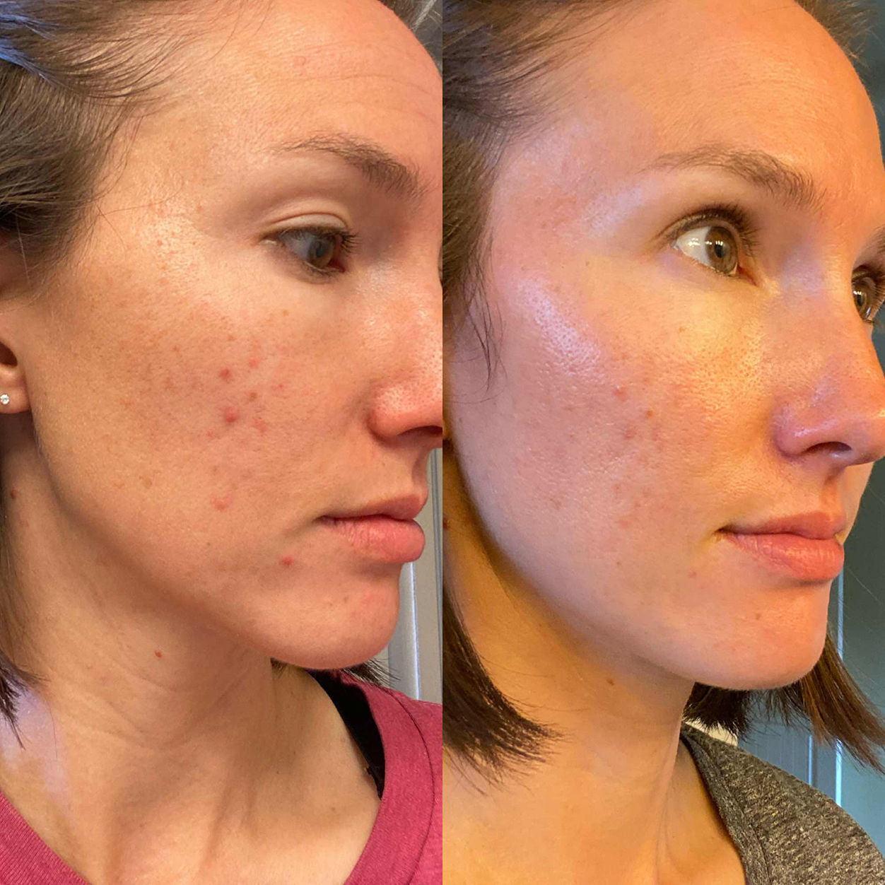 Before and after results of using BalmLabs ClearBalm Gentle Foam Cleanser